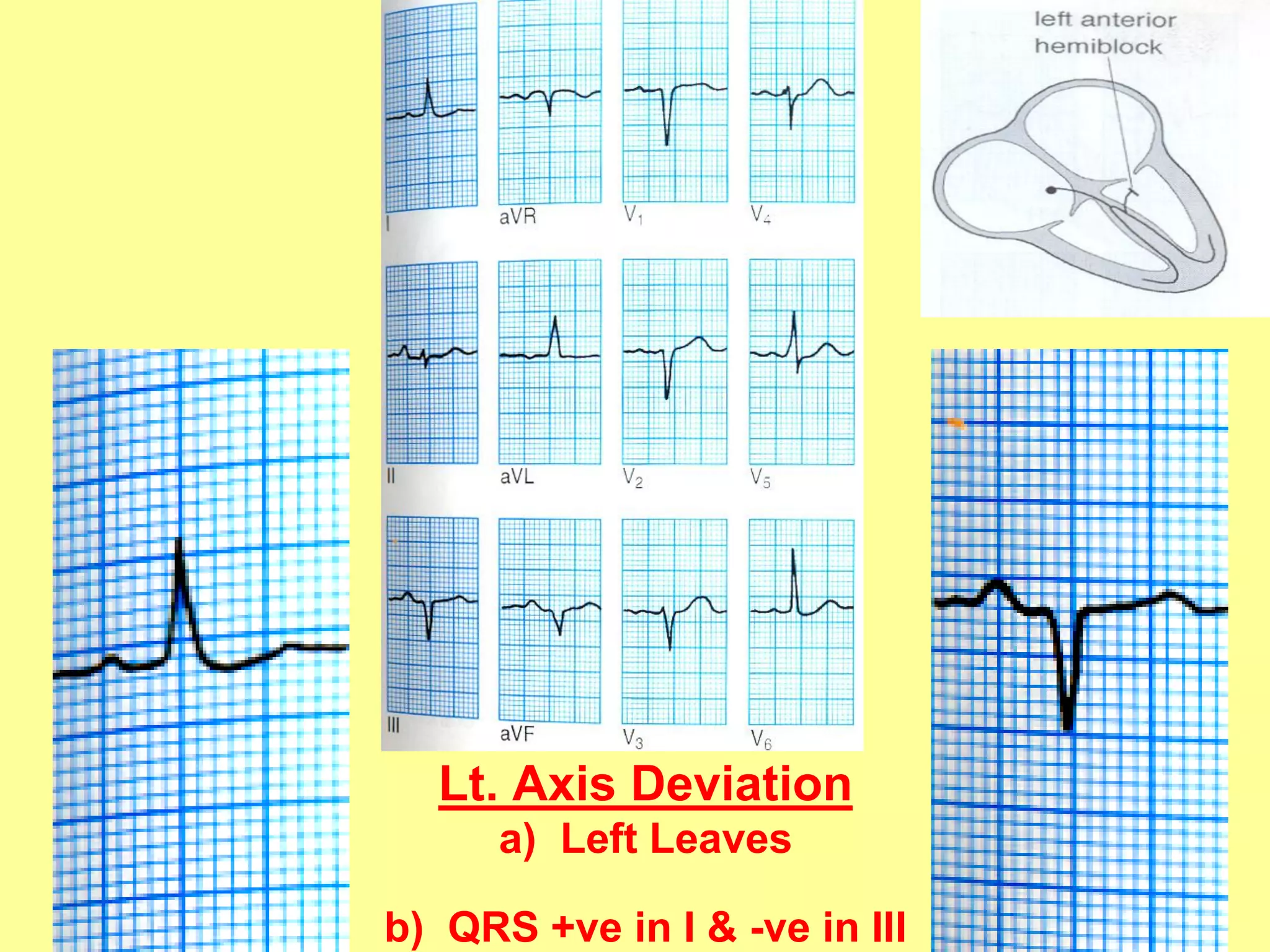 Lt. Axis Deviation
a) Left Leaves
22

b) QRS +ve in I & -ve in III

 