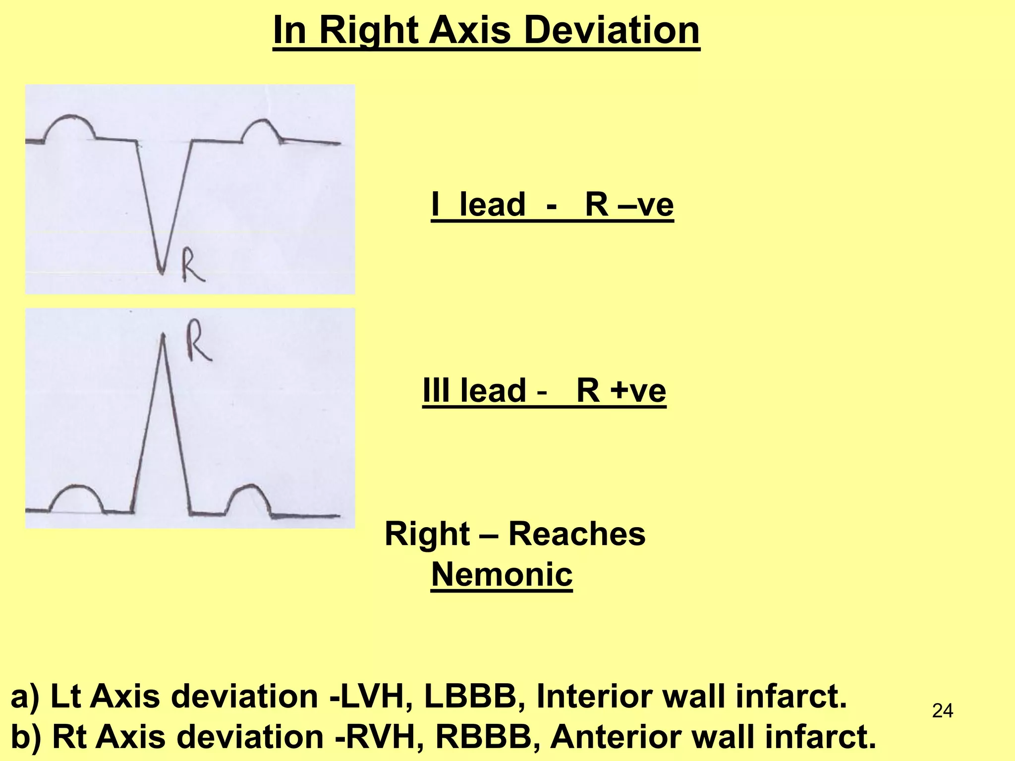 In Right Axis Deviation

I lead - R –ve

III lead - R +ve

Right – Reaches
Nemonic

a) Lt Axis deviation -LVH, LBBB, Interior wall infarct.
b) Rt Axis deviation -RVH, RBBB, Anterior wall infarct.

24

 