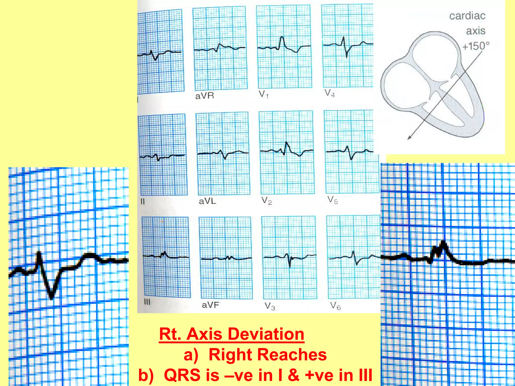 Rt. Axis Deviation
a) Right Reaches
b) QRS is –ve in I & +ve in III

25

 