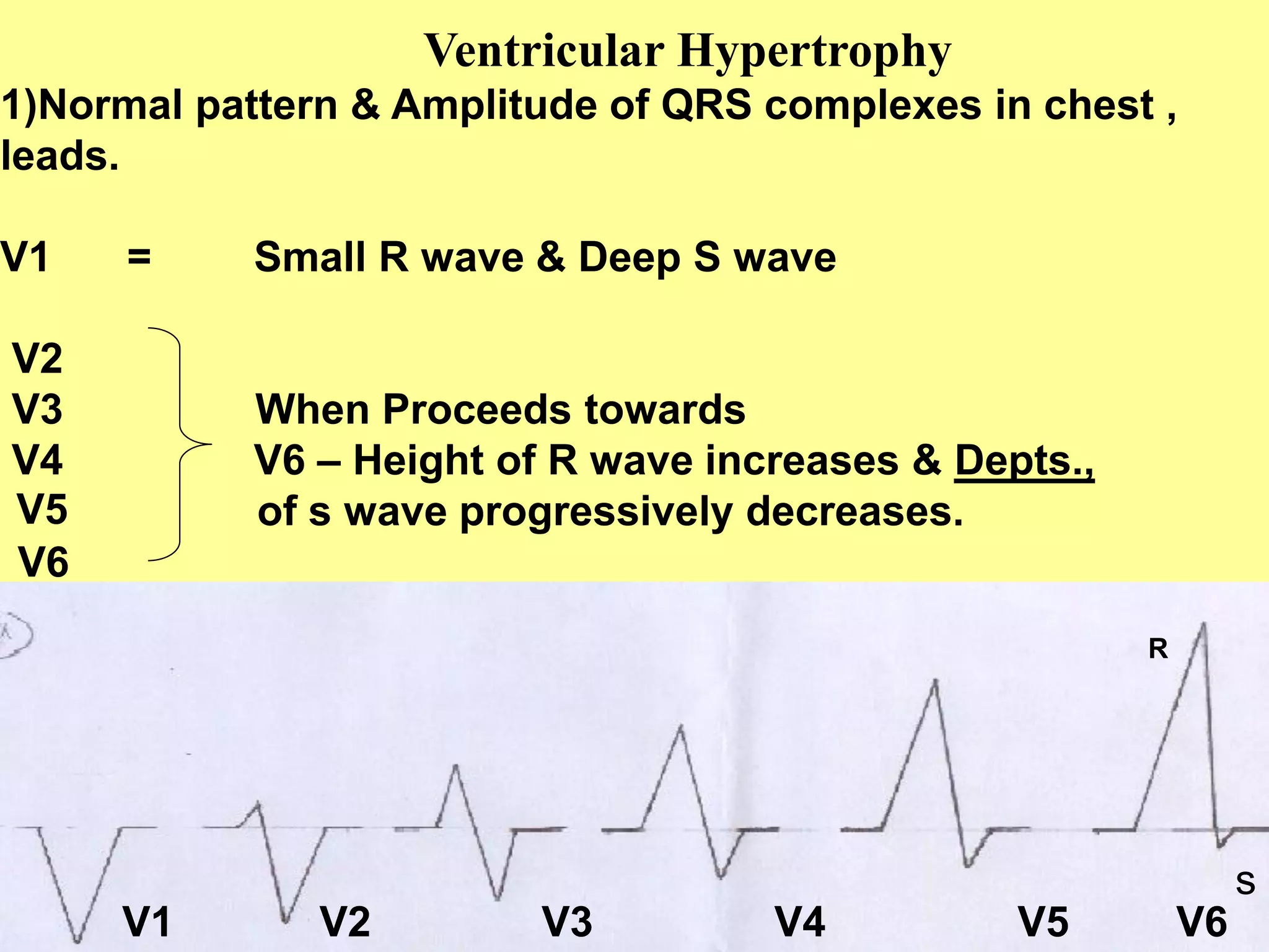Ventricular Hypertrophy
1)Normal pattern & Amplitude of QRS complexes in chest ,
leads.
V1

=

V2
V3
V4
V5
V6

Small R wave & Deep S wave

When Proceeds towards
V6 – Height of R wave increases & Depts.,
of s wave progressively decreases.
R

27

V1

V2

V3

V4

V5

V6

s

 