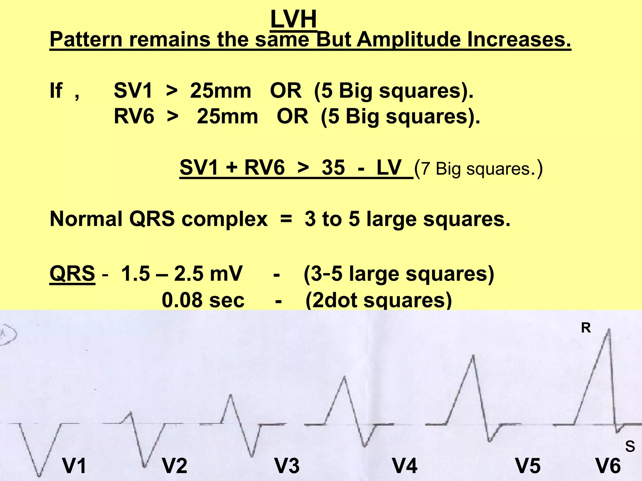 LVH

Pattern remains the same But Amplitude Increases.
If ,

SV1 > 25mm OR (5 Big squares).
RV6 > 25mm OR (5 Big squares).
SV1 + RV6 > 35 - LV (7 Big squares.)

Normal QRS complex = 3 to 5 large squares.
QRS - 1.5 – 2.5 mV
0.08 sec

-

(3-5 large squares)
(2dot squares)
R

28

V1

V2

V3

V4

V5

V6

s

 