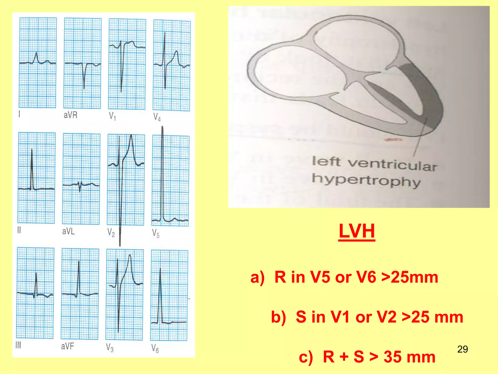 LVH
a) R in V5 or V6 >25mm
b) S in V1 or V2 >25 mm
c) R + S > 35 mm

29

 