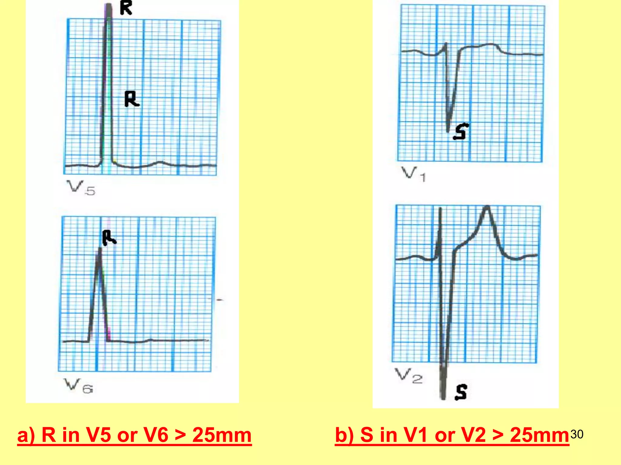 a) R in V5 or V6 > 25mm

b) S in V1 or V2 > 25mm30

 