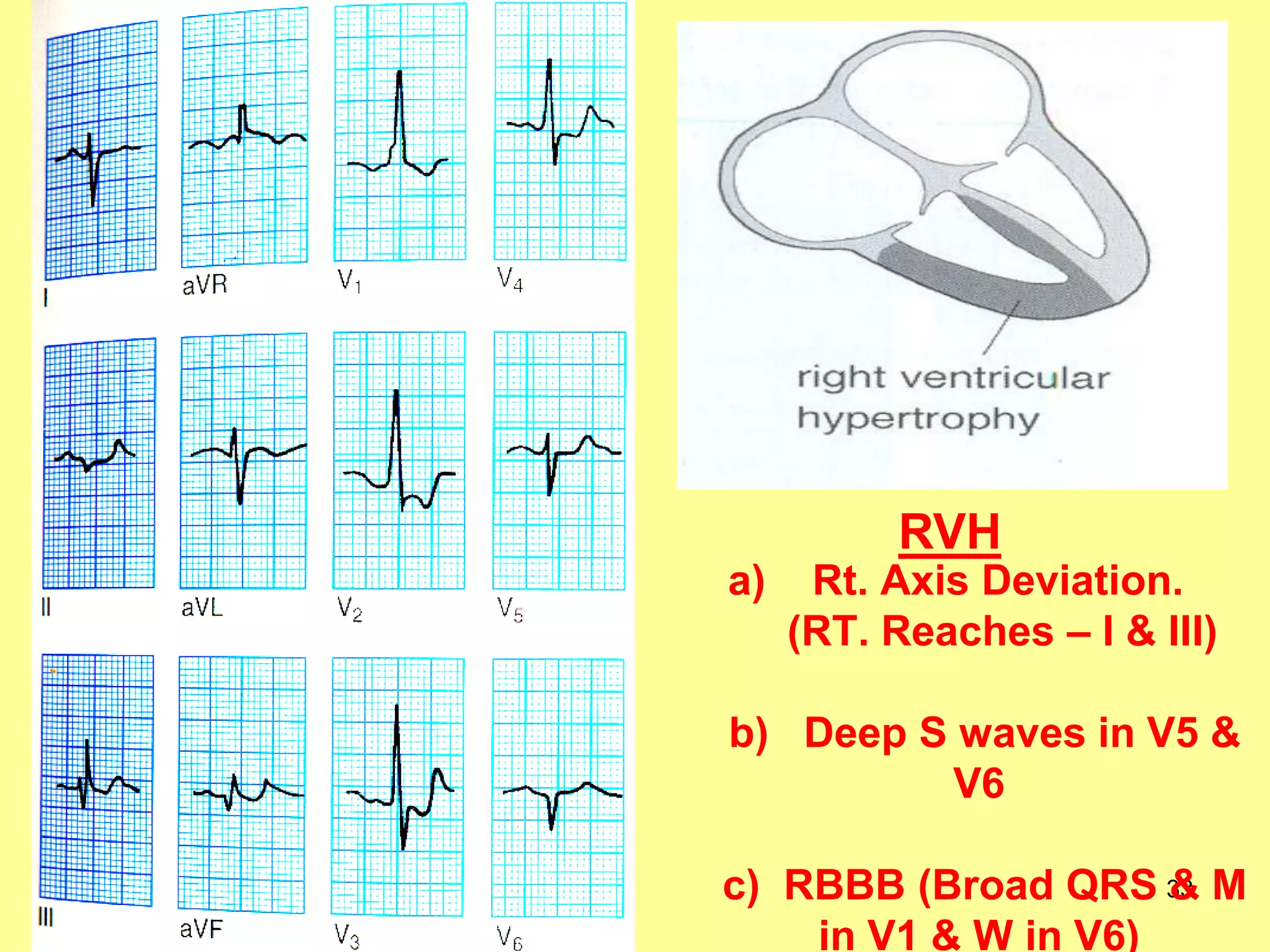 RVH
a)

Rt. Axis Deviation.
(RT. Reaches – I & III)

b) Deep S waves in V5 &
V6
c) RBBB (Broad QRS 33 M
&
in V1 & W in V6)

 