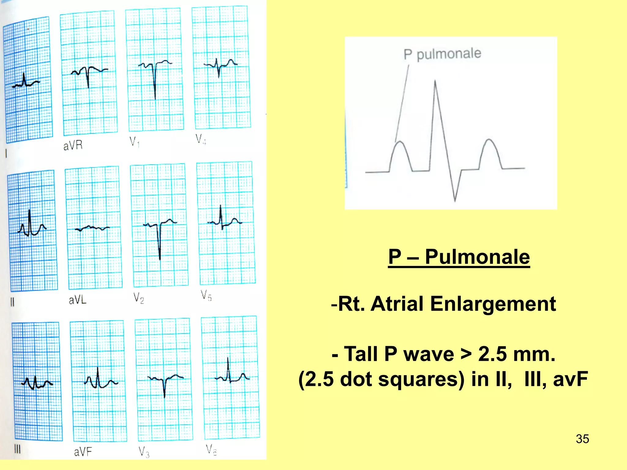 P – Pulmonale
-Rt. Atrial Enlargement
- Tall P wave > 2.5 mm.
(2.5 dot squares) in II, III, avF
35

 