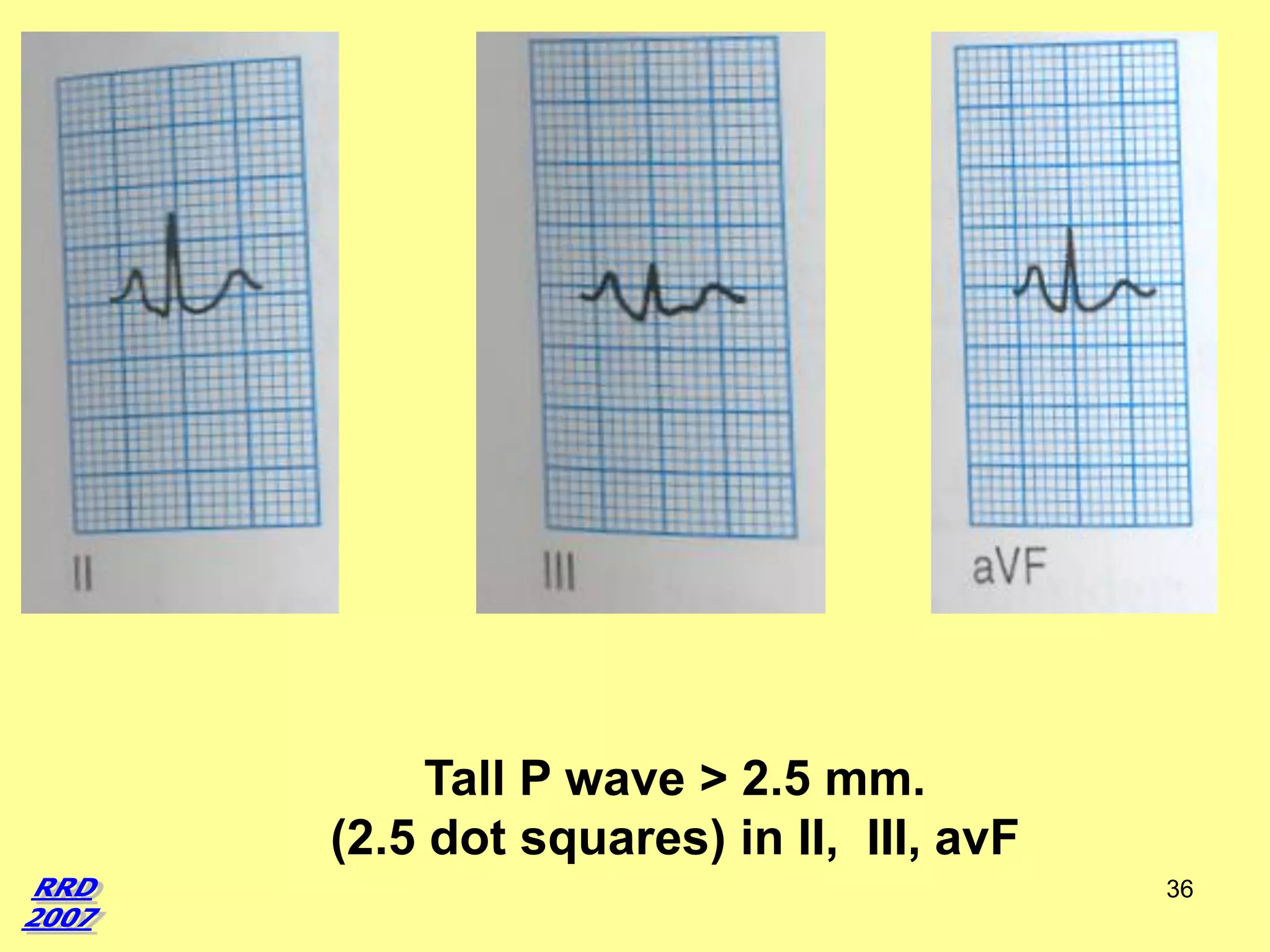 Tall P wave > 2.5 mm.
(2.5 dot squares) in II, III, avF
36

 
