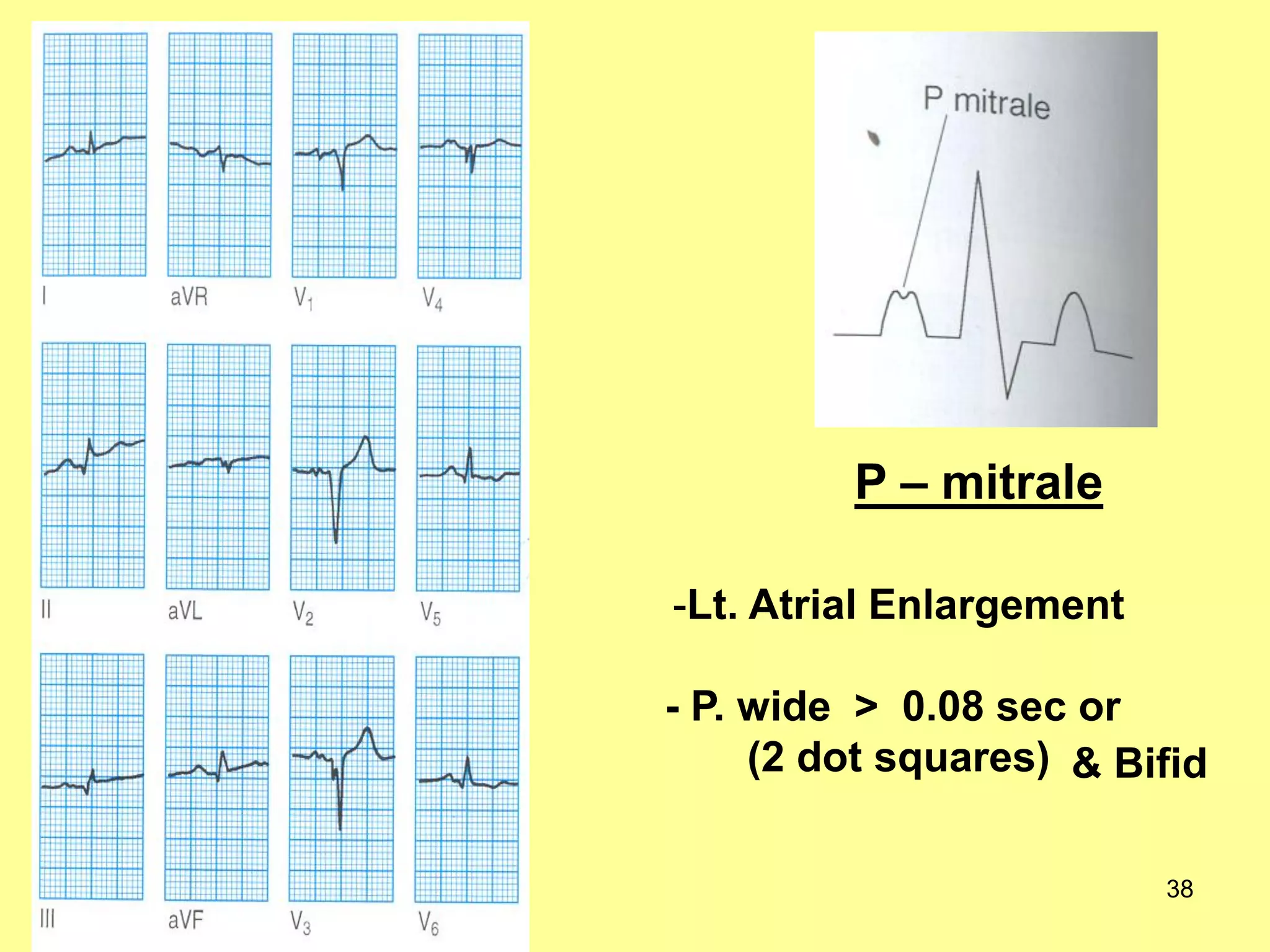 P – mitrale
-Lt. Atrial Enlargement
- P. wide > 0.08 sec or
(2 dot squares) & Bifid
38

 