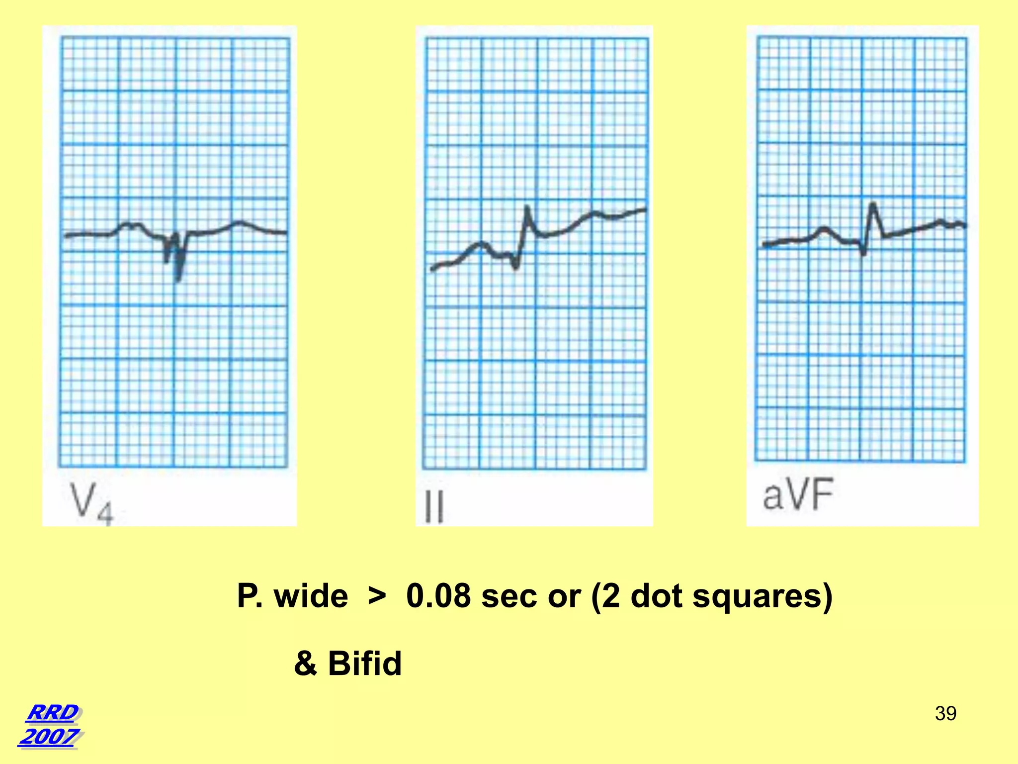 P. wide > 0.08 sec or (2 dot squares)

& Bifid
39

 