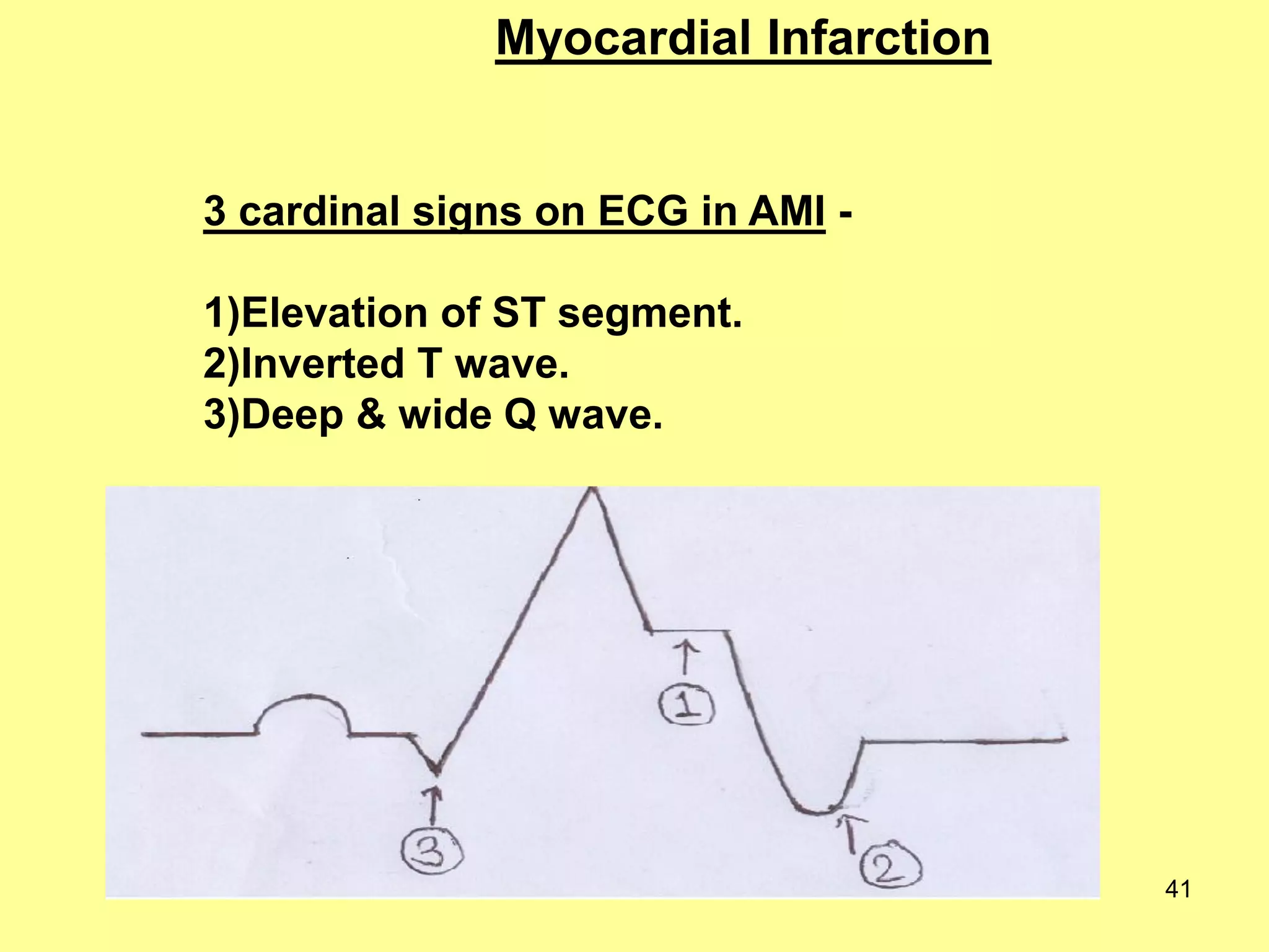 Myocardial Infarction

3 cardinal signs on ECG in AMI -

1)Elevation of ST segment.
2)Inverted T wave.
3)Deep & wide Q wave.

41

 