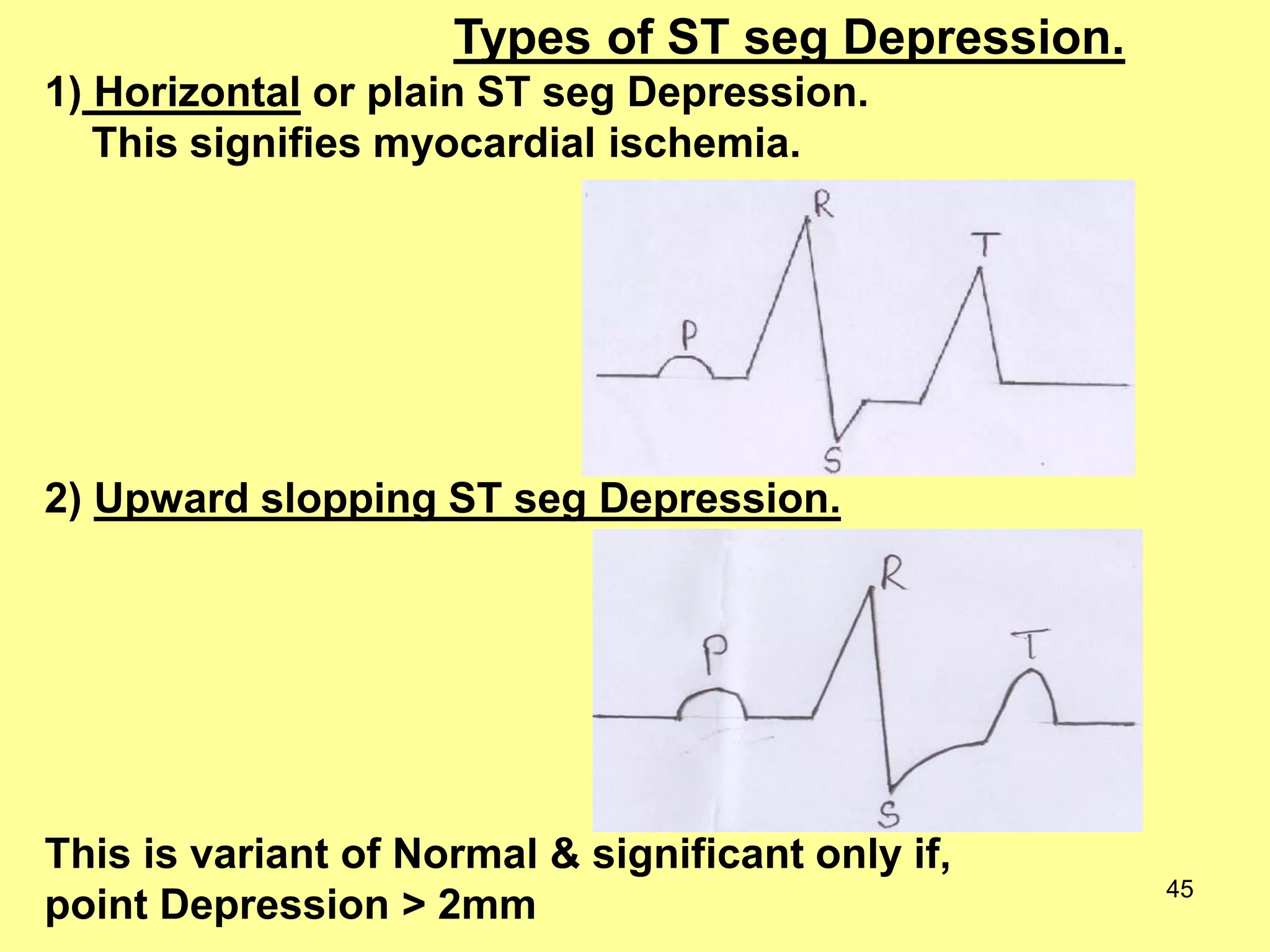 Types of ST seg Depression.
1) Horizontal or plain ST seg Depression.
This signifies myocardial ischemia.

2) Upward slopping ST seg Depression.

This is variant of Normal & significant only if,
point Depression > 2mm

45

 