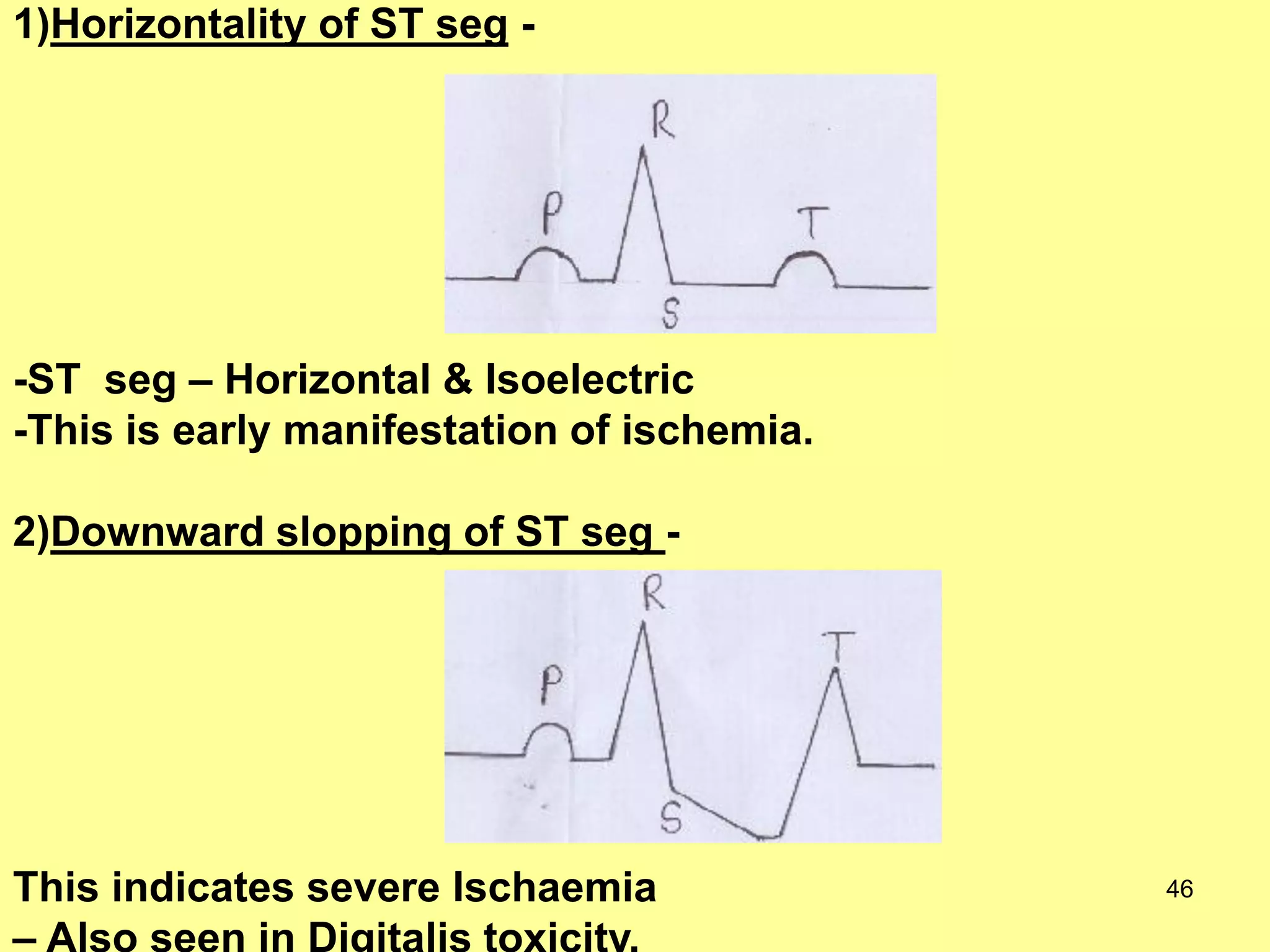 1)Horizontality of ST seg -

-ST seg – Horizontal & Isoelectric
-This is early manifestation of ischemia.
2)Downward slopping of ST seg -

This indicates severe Ischaemia

46

 