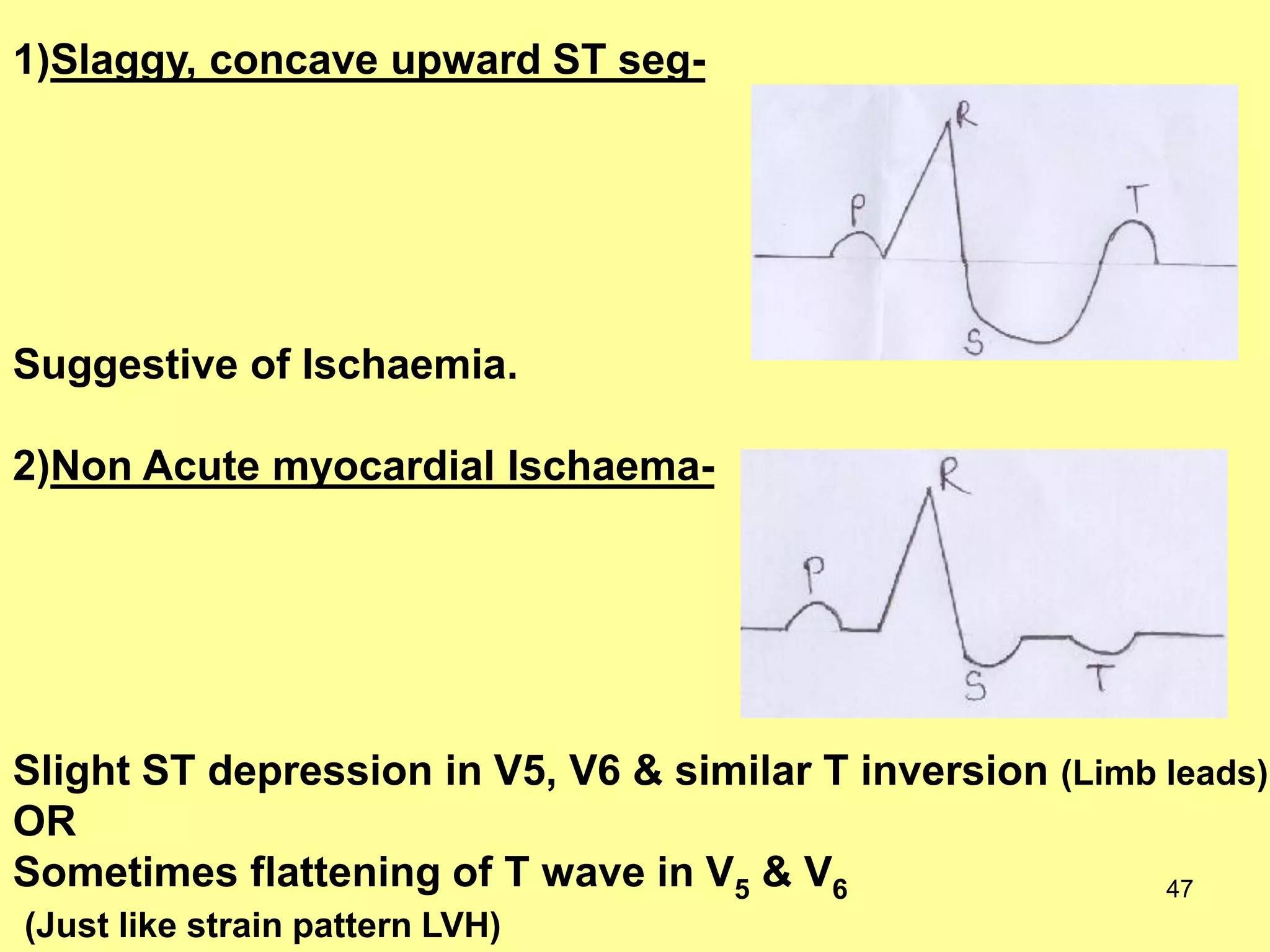 1)Slaggy, concave upward ST seg-

Suggestive of Ischaemia.
2)Non Acute myocardial Ischaema-

Slight ST depression in V5, V6 & similar T inversion (Limb leads)
OR
Sometimes flattening of T wave in V5 & V6
47
(Just like strain pattern LVH)

 