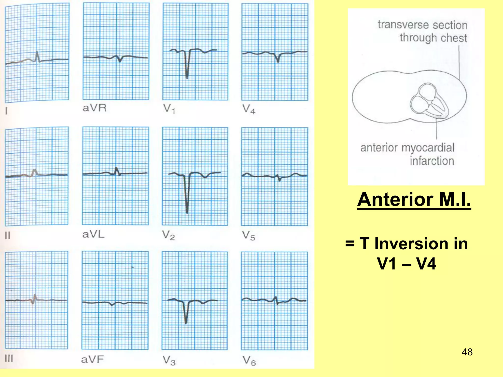 Anterior M.I.
= T Inversion in
V1 – V4

48

 