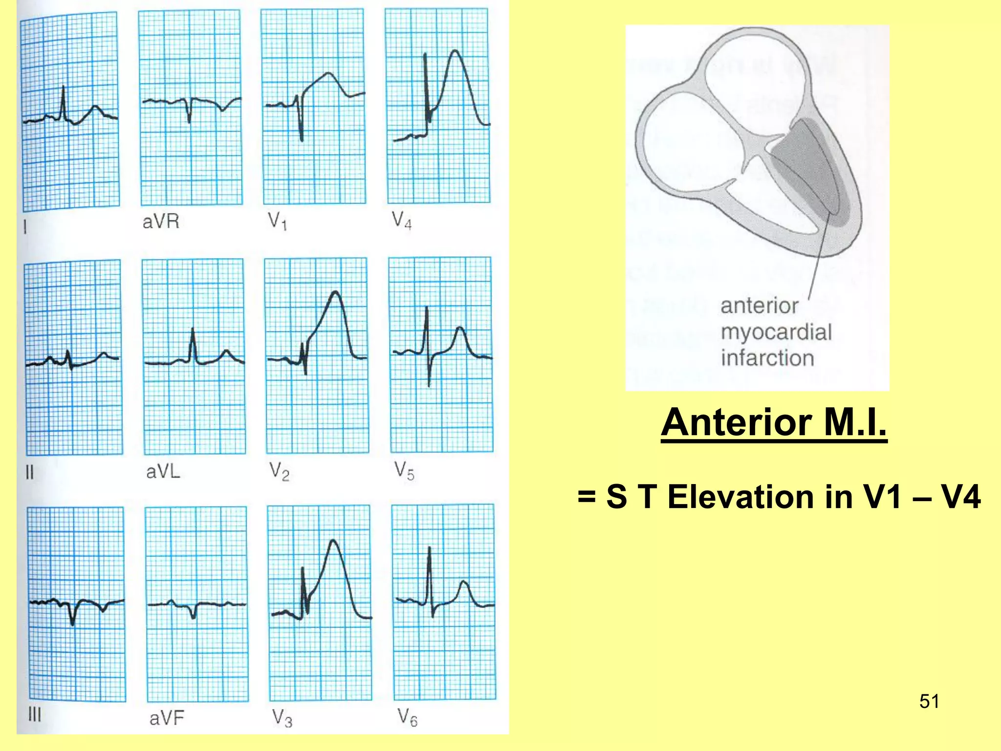 Anterior M.I.
= S T Elevation in V1 – V4

51

 