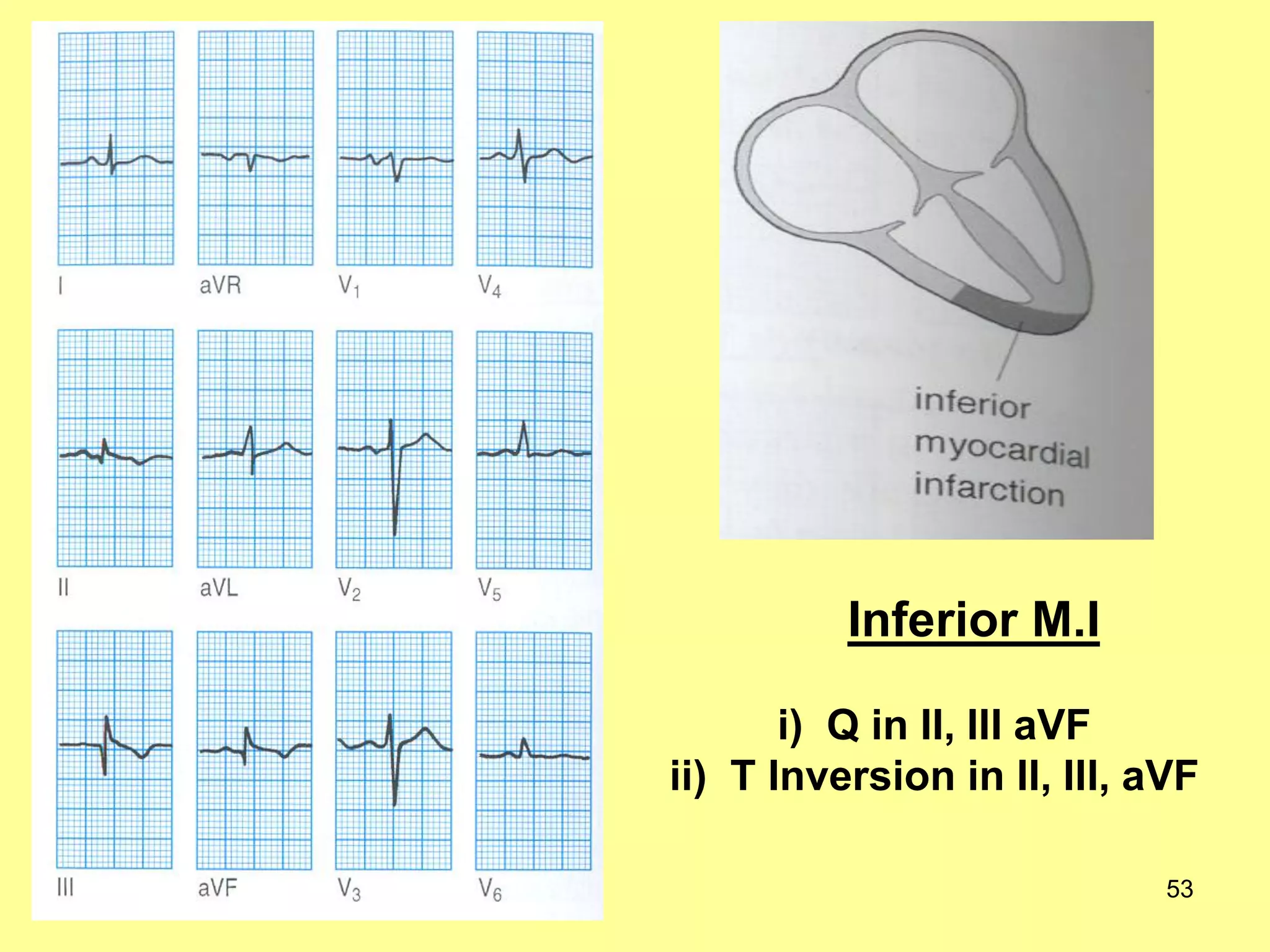 Inferior M.I
i) Q in II, III aVF
ii) T Inversion in II, III, aVF
53

 