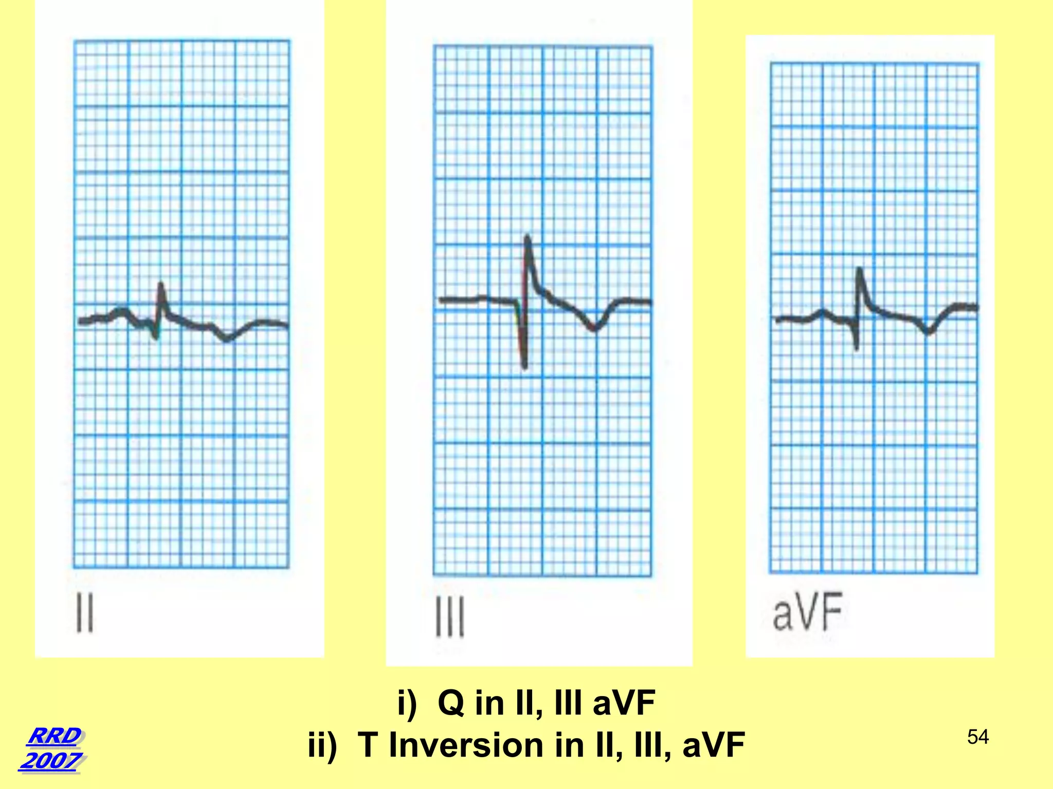 i) Q in II, III aVF
ii) T Inversion in II, III, aVF

54

 