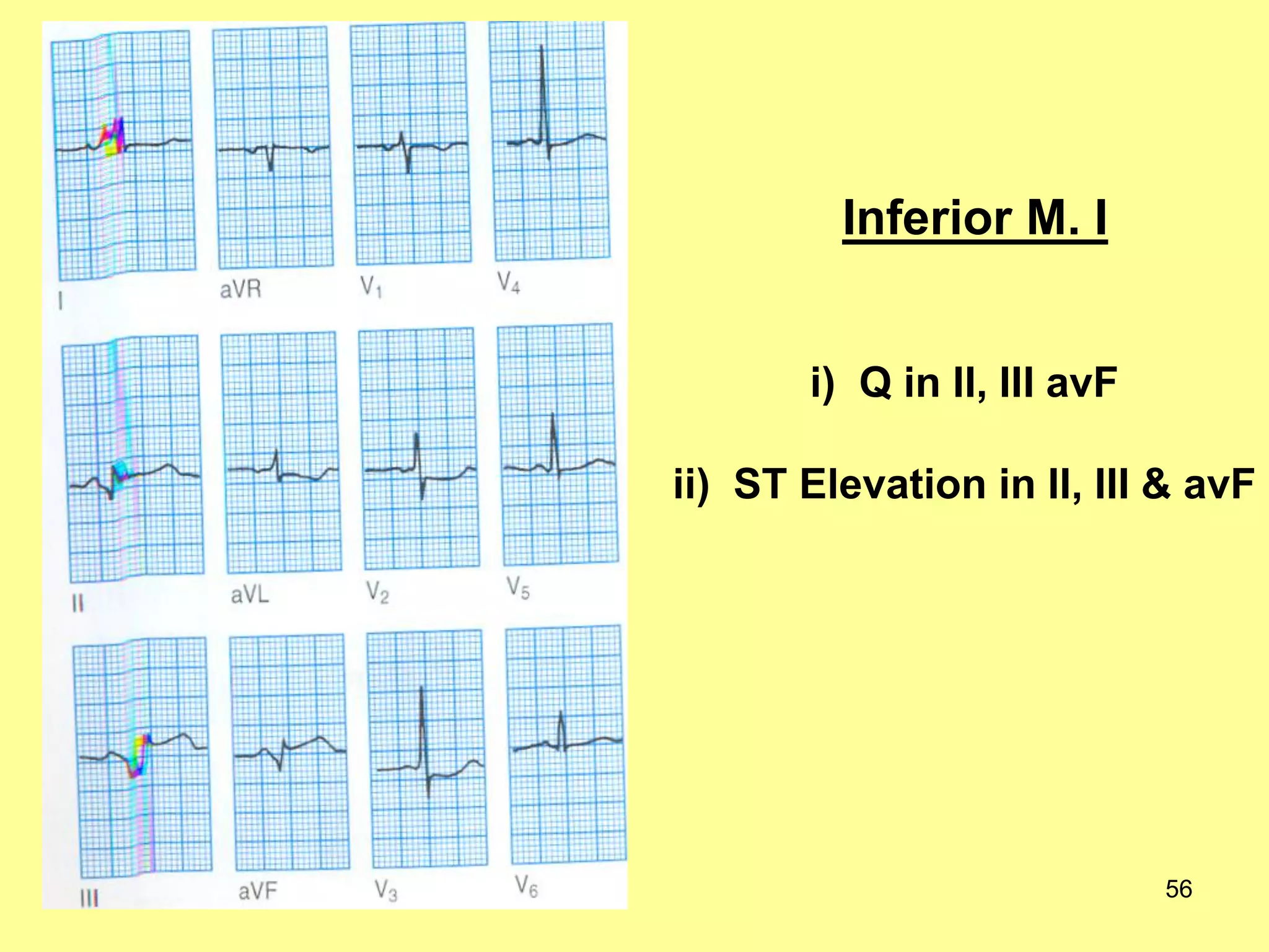 Inferior M. I
i) Q in II, III avF

ii) ST Elevation in II, III & avF

56

 