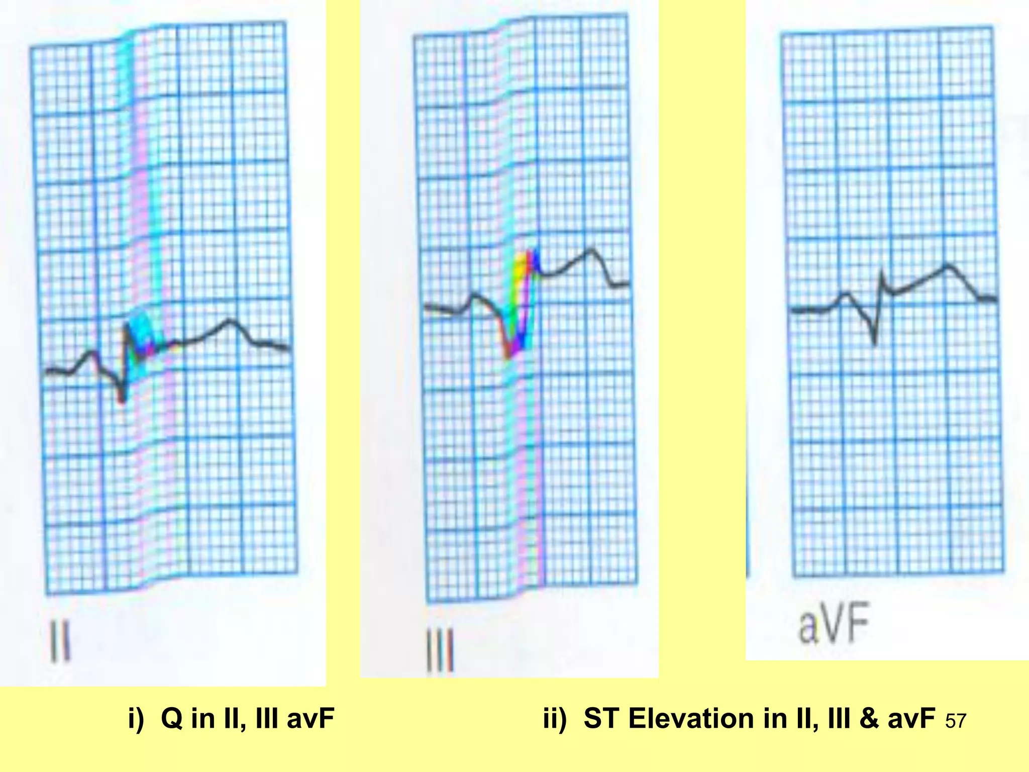 i) Q in II, III avF

ii) ST Elevation in II, III & avF 57

 