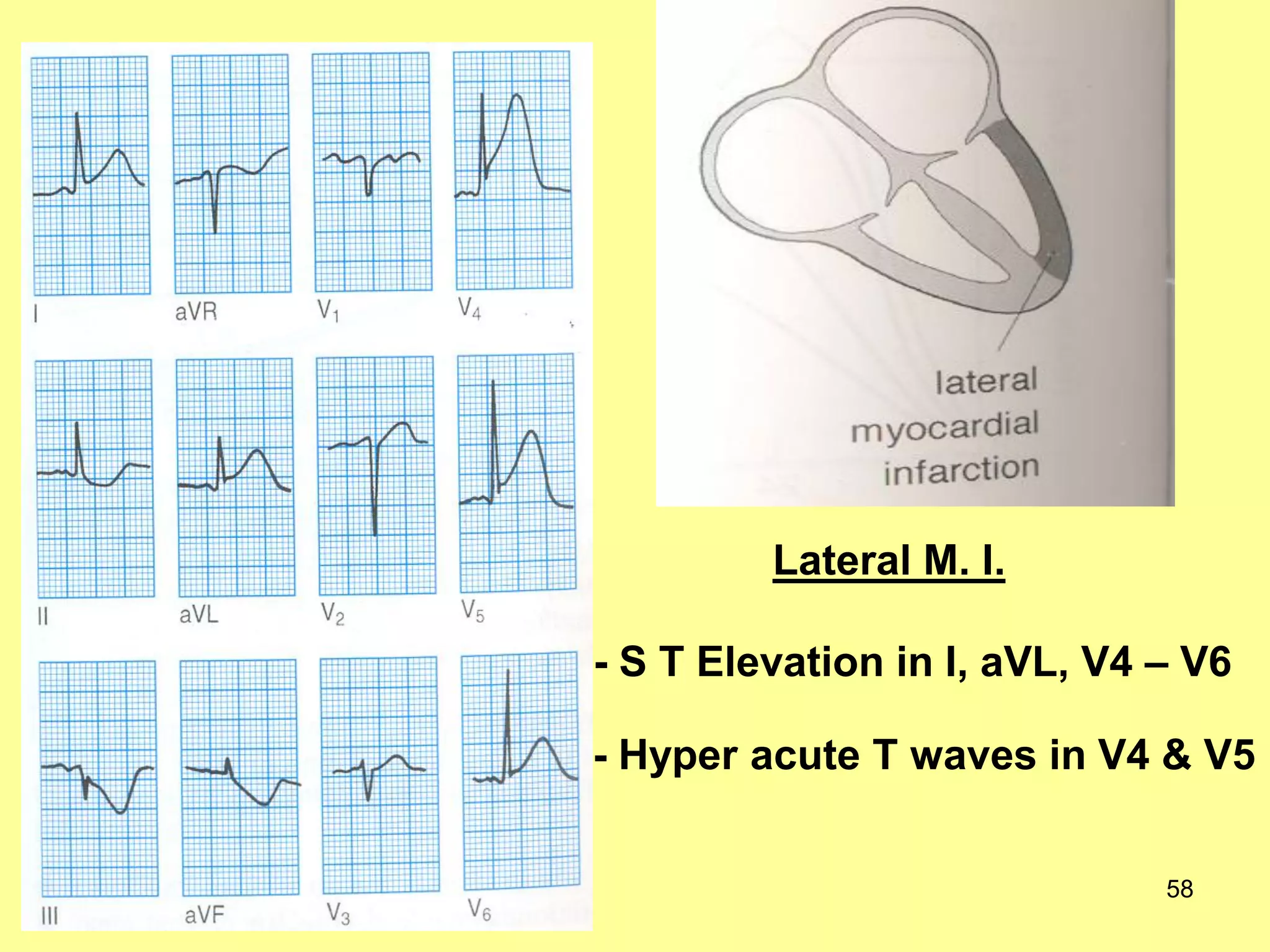 Lateral M. I.

- S T Elevation in I, aVL, V4 – V6
- Hyper acute T waves in V4 & V5
58

 