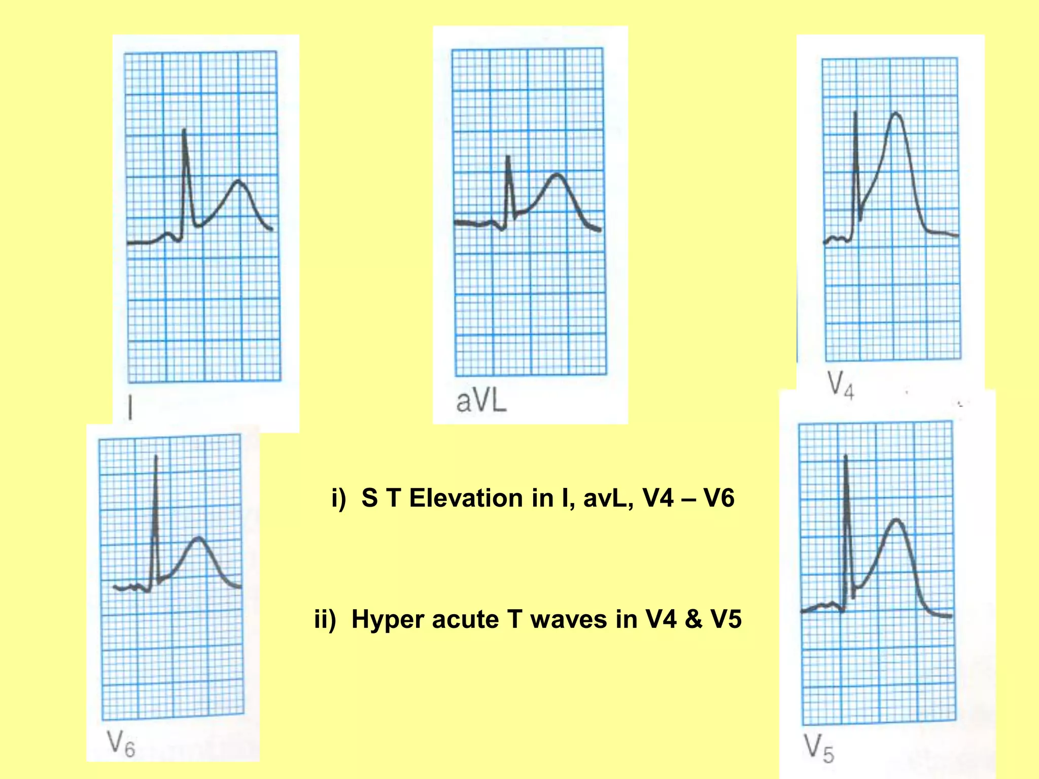 i) S T Elevation in I, avL, V4 – V6

ii) Hyper acute T waves in V4 & V5

59

 