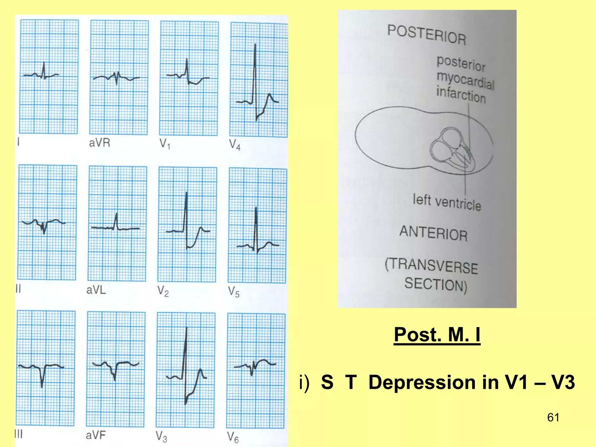 Post. M. I
i) S T Depression in V1 – V3
61

 