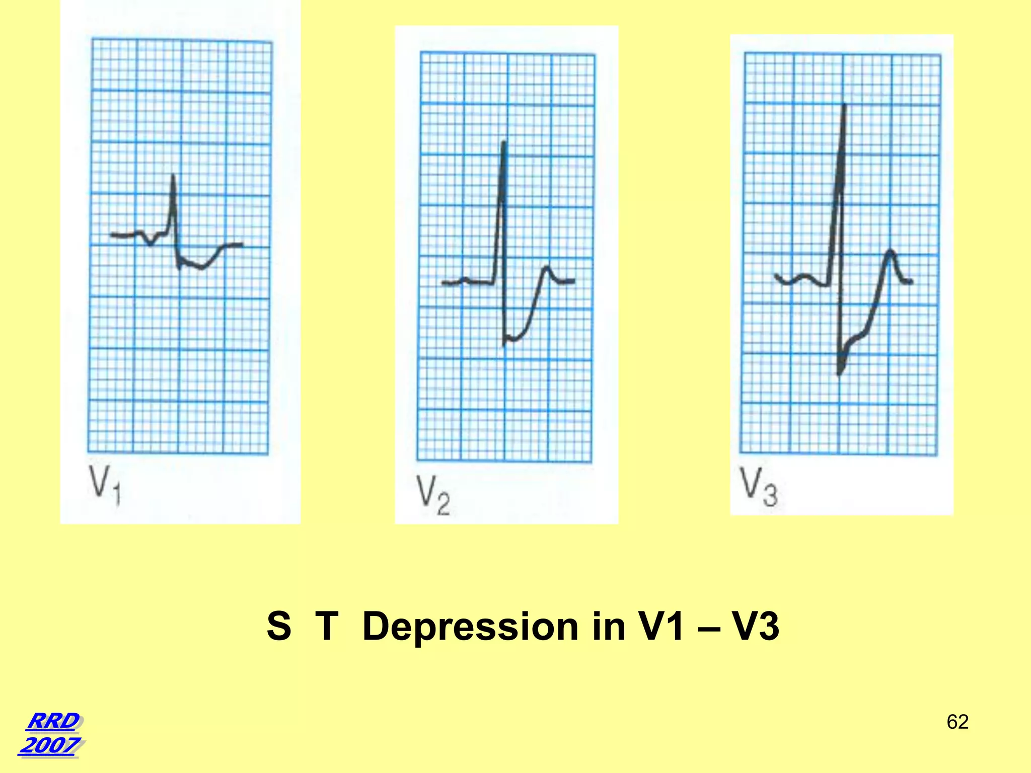 S T Depression in V1 – V3
62

 