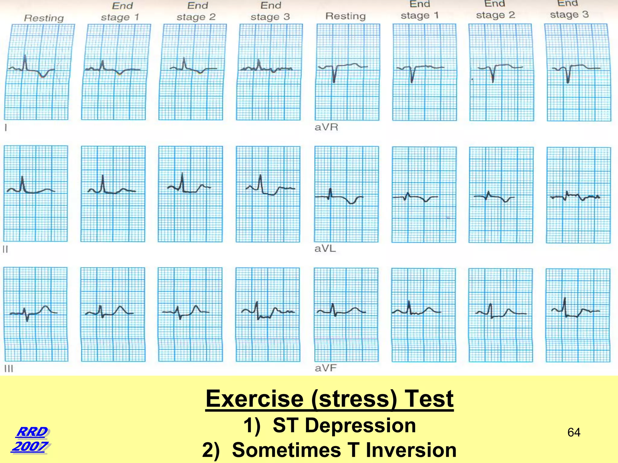 Exercise (stress) Test
1) ST Depression
2) Sometimes T Inversion

64

 