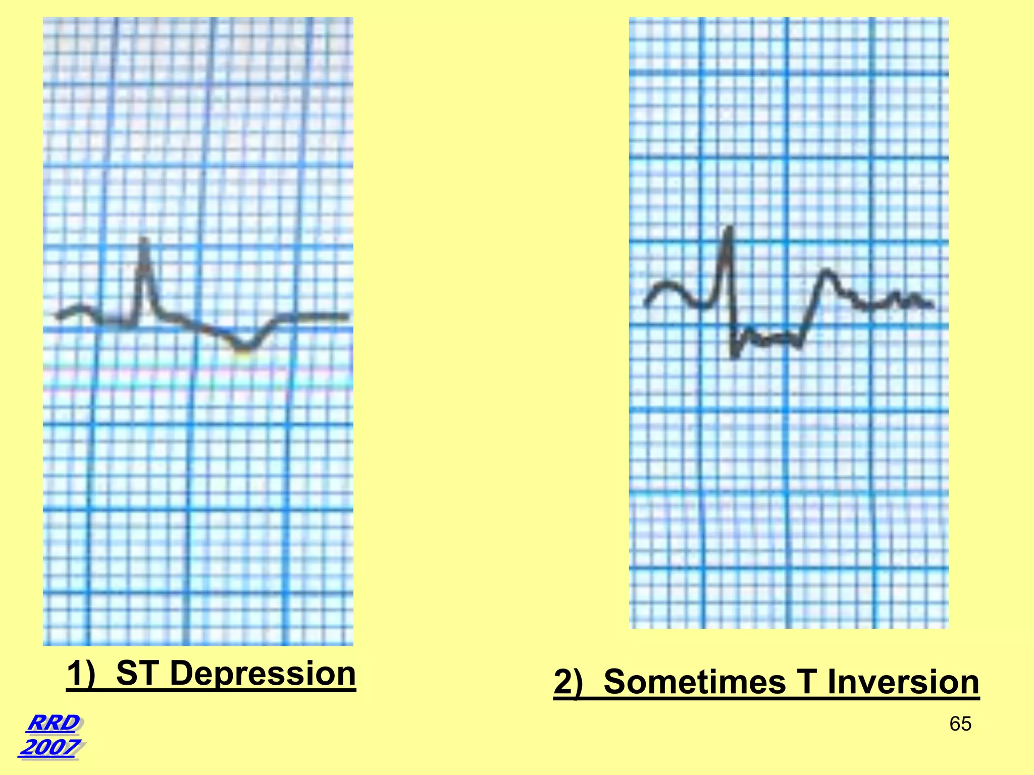 1) ST Depression

2) Sometimes T Inversion
65

 