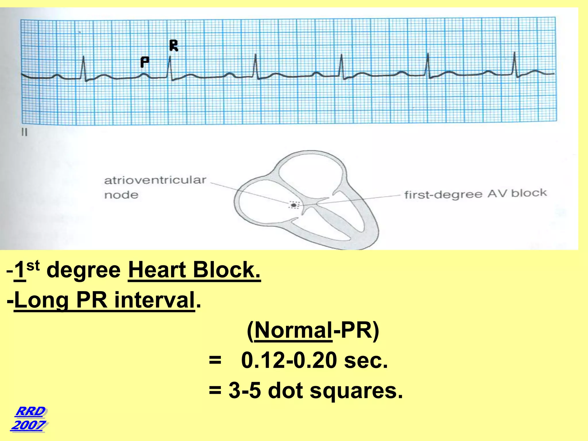 -1st degree Heart Block.
-Long PR interval.
(Normal-PR)
= 0.12-0.20 sec.
= 3-5 dot squares.

 