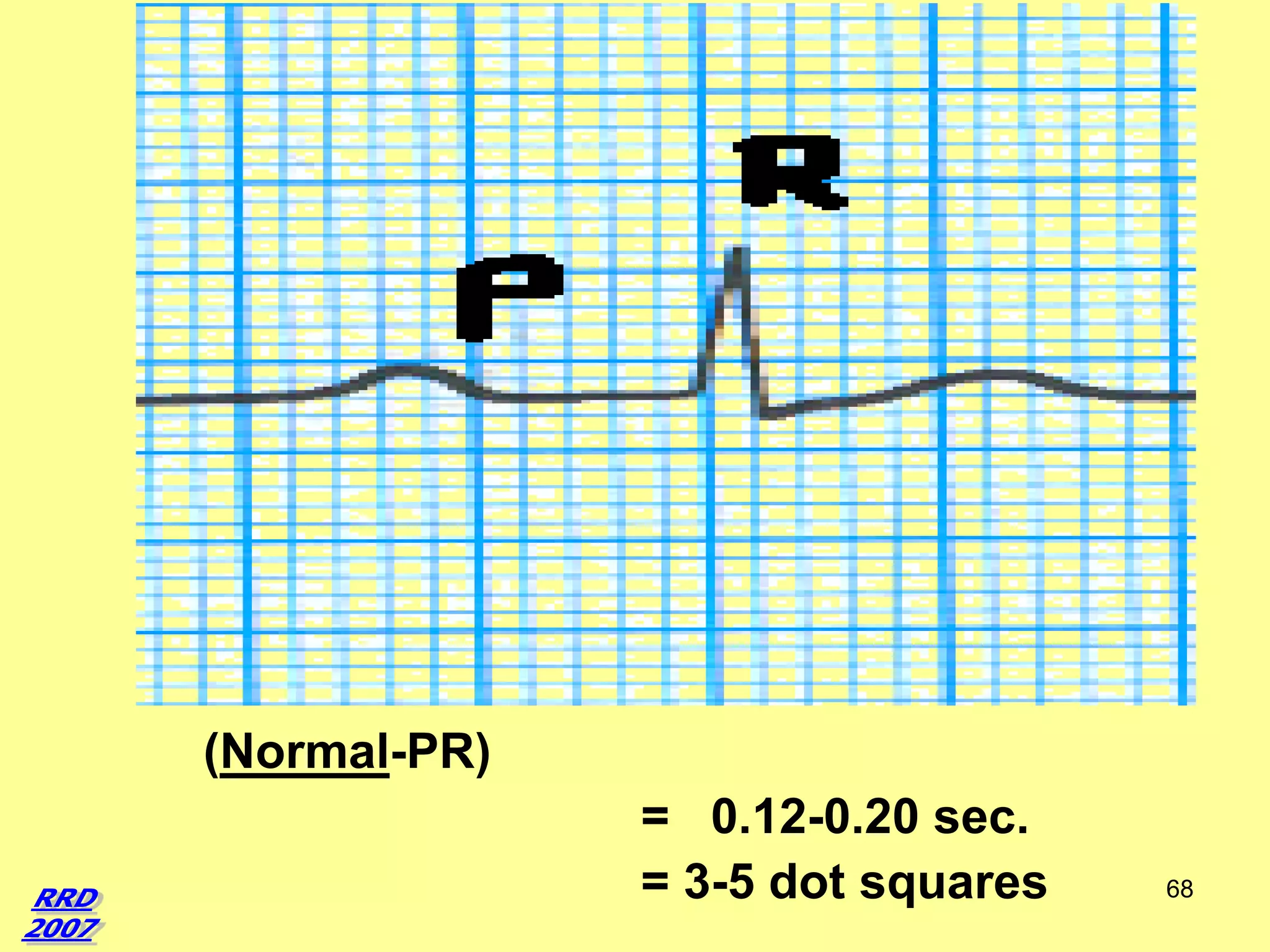 (Normal-PR)
= 0.12-0.20 sec.
= 3-5 dot squares

68

 