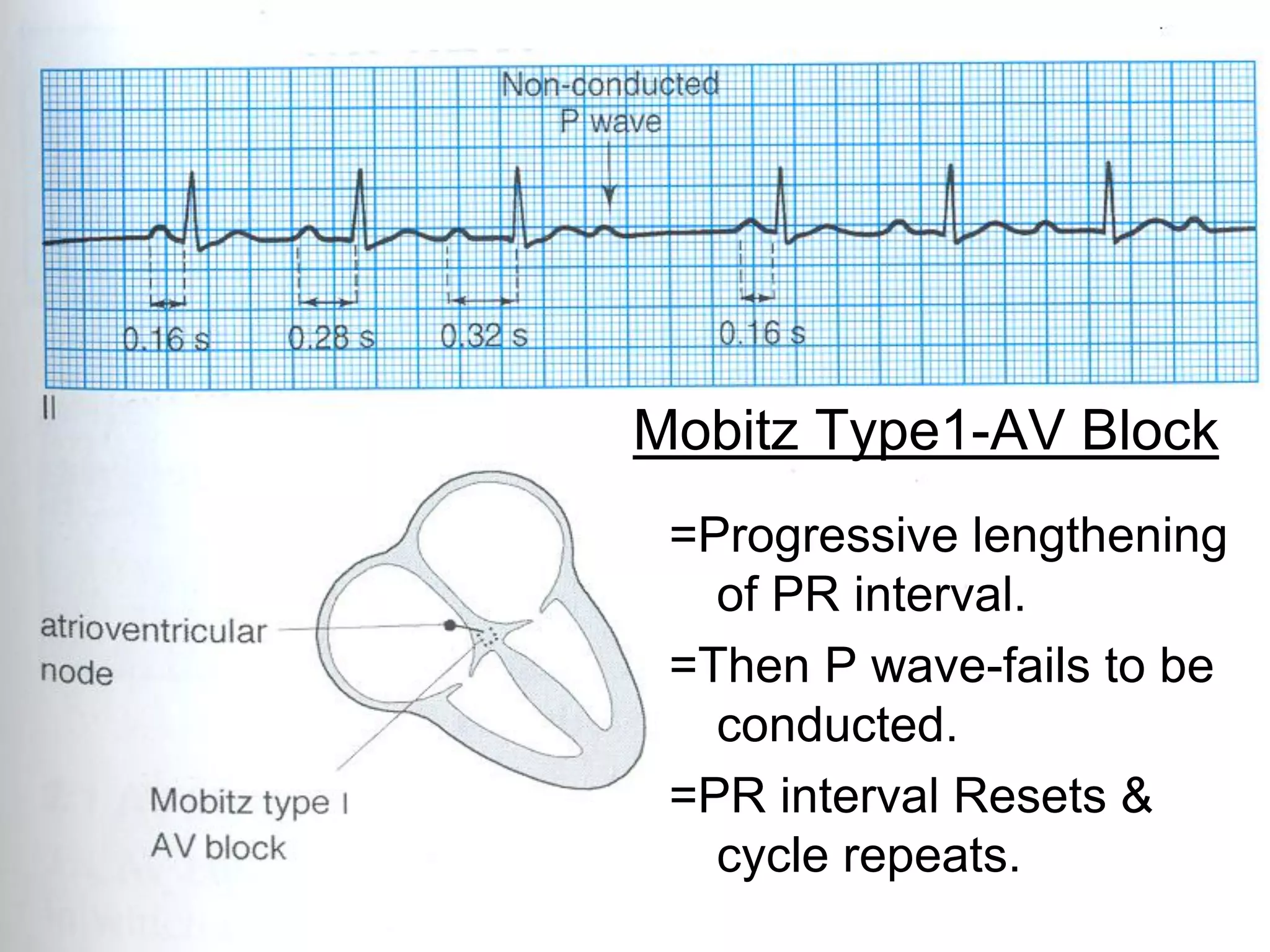 Mobitz Type1-AV Block
=Progressive lengthening
of PR interval.
=Then P wave-fails to be
conducted.
=PR interval Resets &
cycle repeats.
70

 