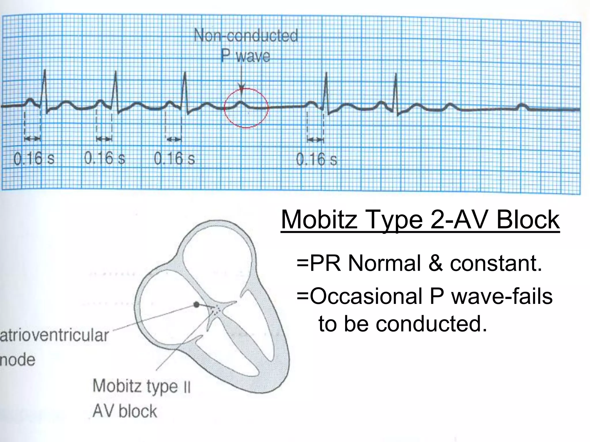 Mobitz Type 2-AV Block
=PR Normal & constant.
=Occasional P wave-fails
to be conducted.

73

 