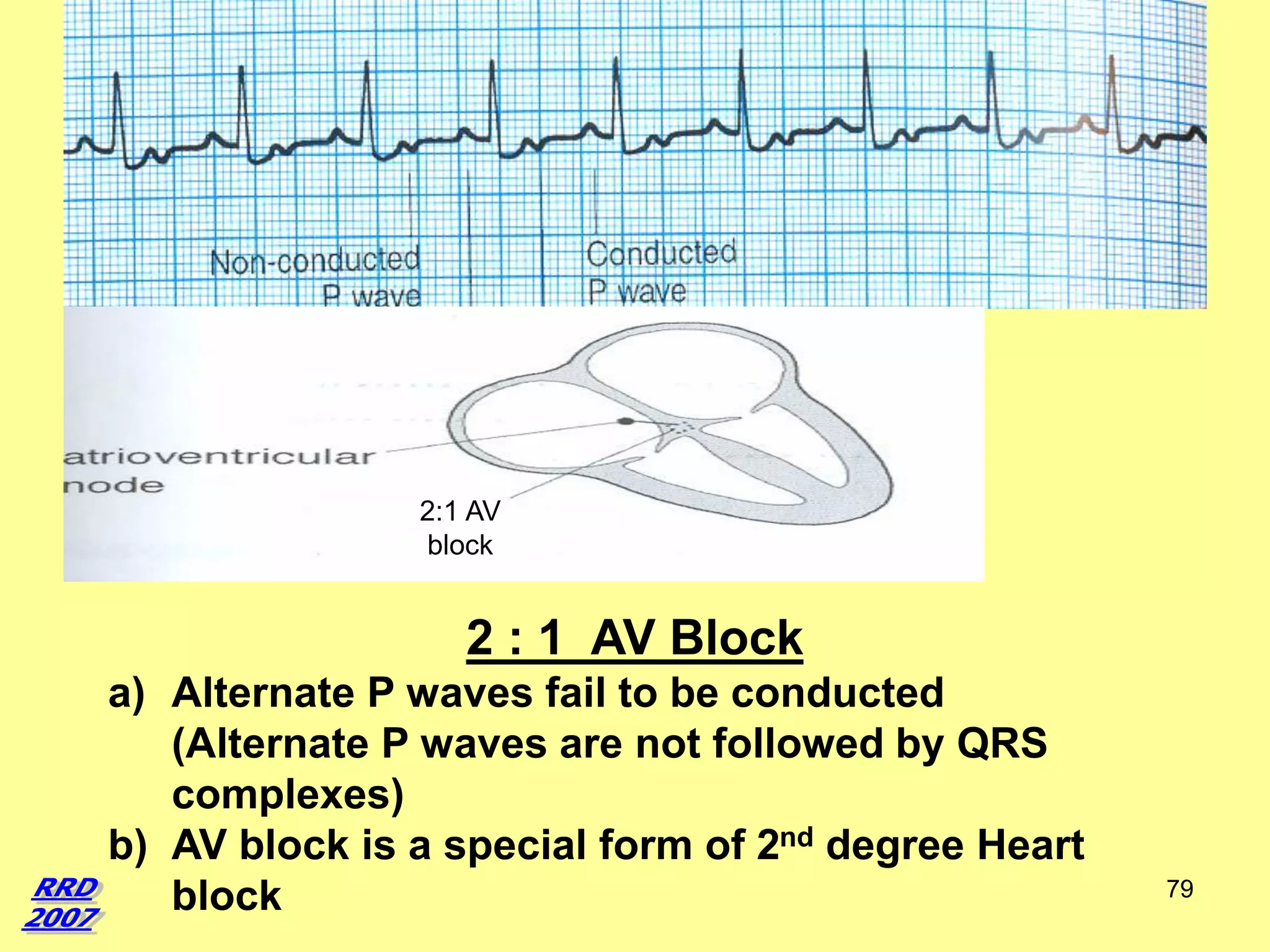 2:1 AV
block

2 : 1 AV Block
a) Alternate P waves fail to be conducted
(Alternate P waves are not followed by QRS
complexes)
b) AV block is a special form of 2nd degree Heart
block

79

 