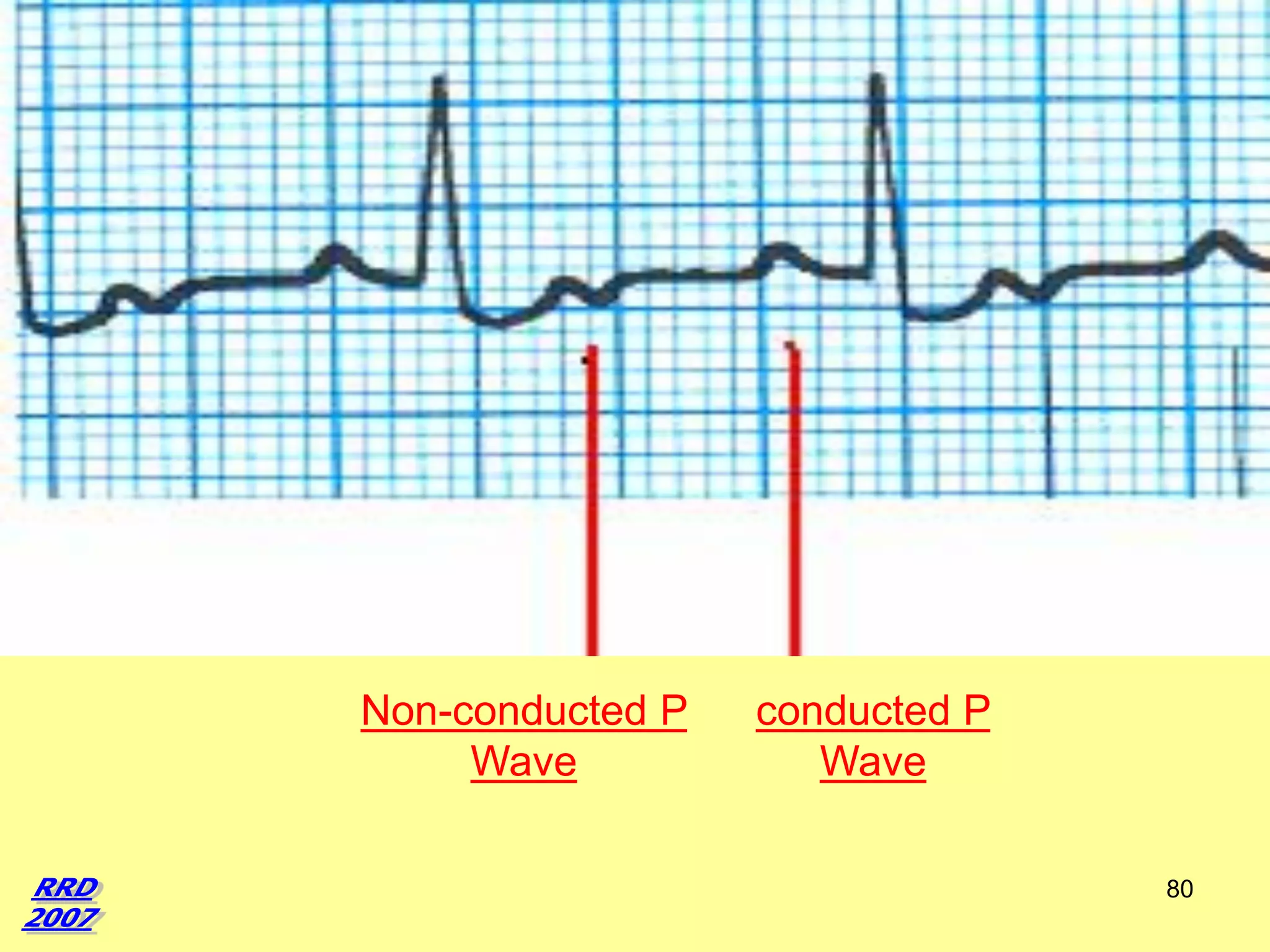 Non-conducted P
Wave

conducted P
Wave
80

 
