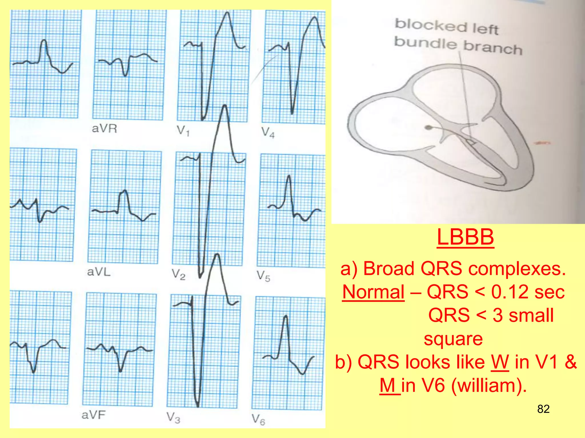 LBBB
a) Broad QRS complexes.
Normal – QRS < 0.12 sec
QRS < 3 small
square
b) QRS looks like W in V1 &
M in V6 (william).
82

 