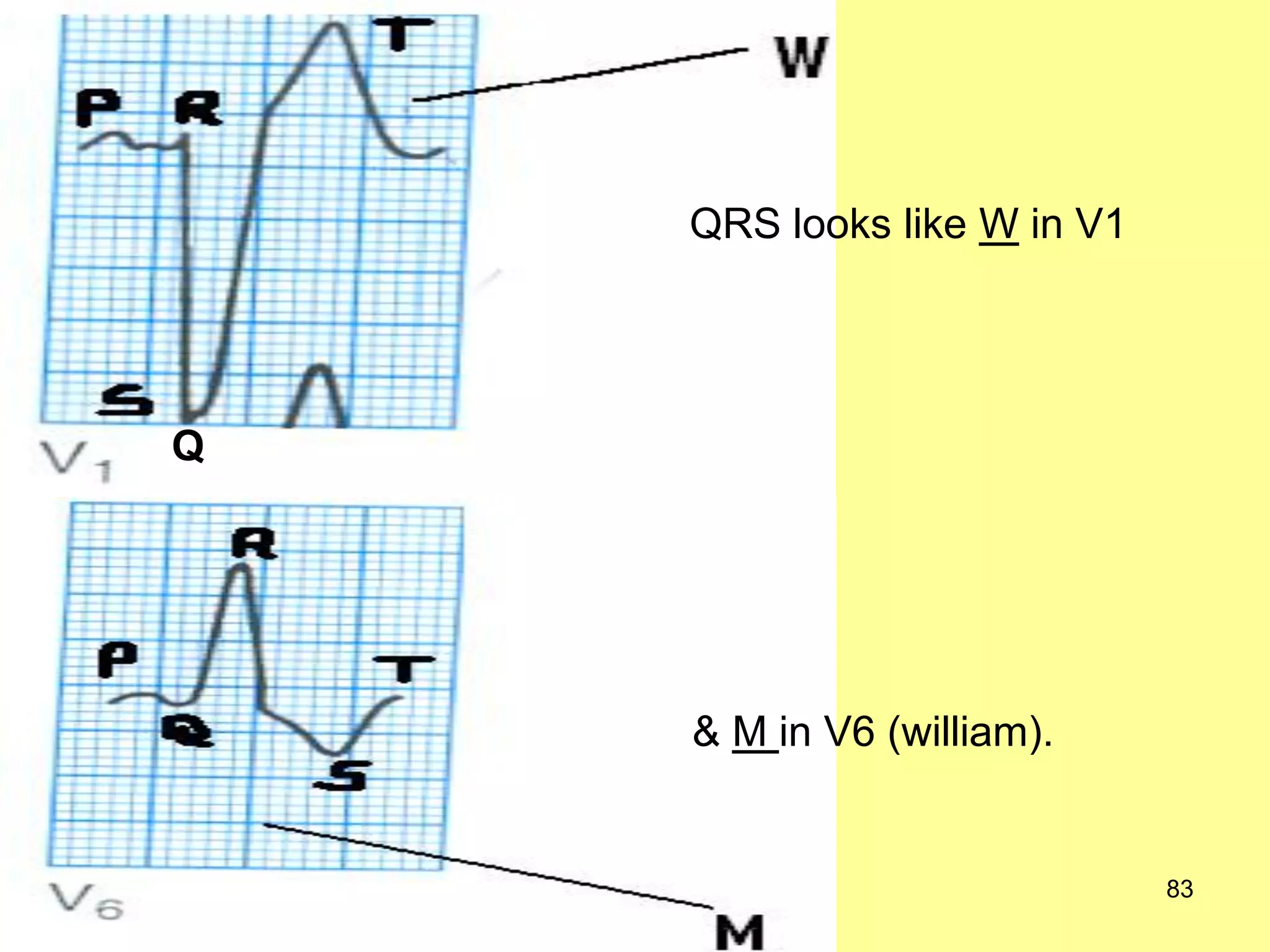 QRS looks like W in V1

Q

& M in V6 (william).

83

 