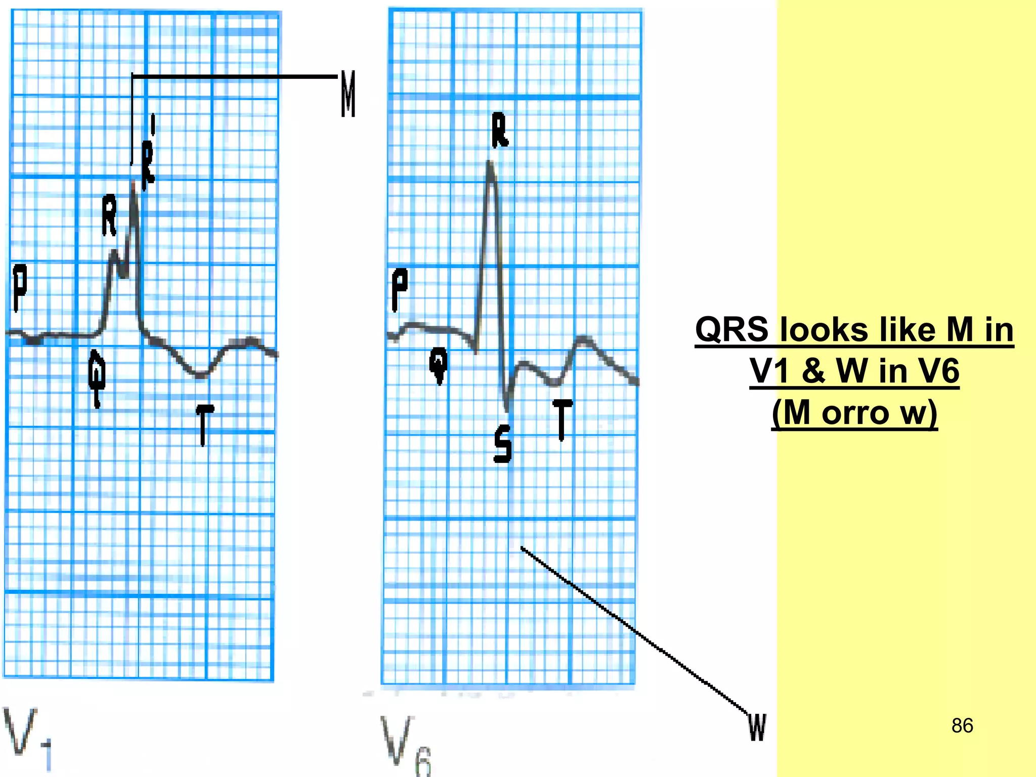 QRS looks like M in
V1 & W in V6
(M orro w)

86

 