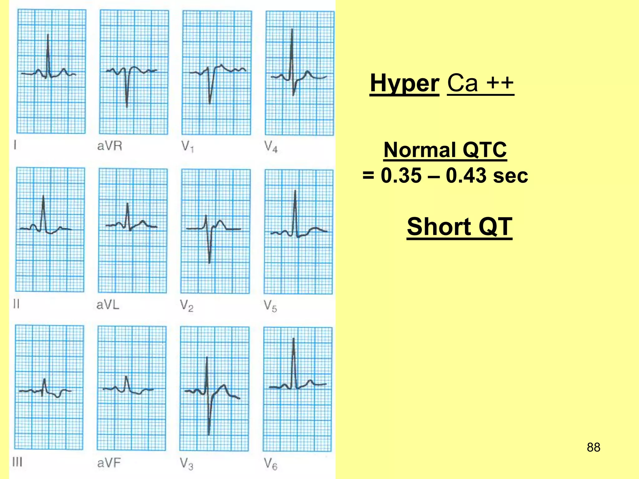 Hyper Ca ++
Normal QTC
= 0.35 – 0.43 sec

Short QT

88

 