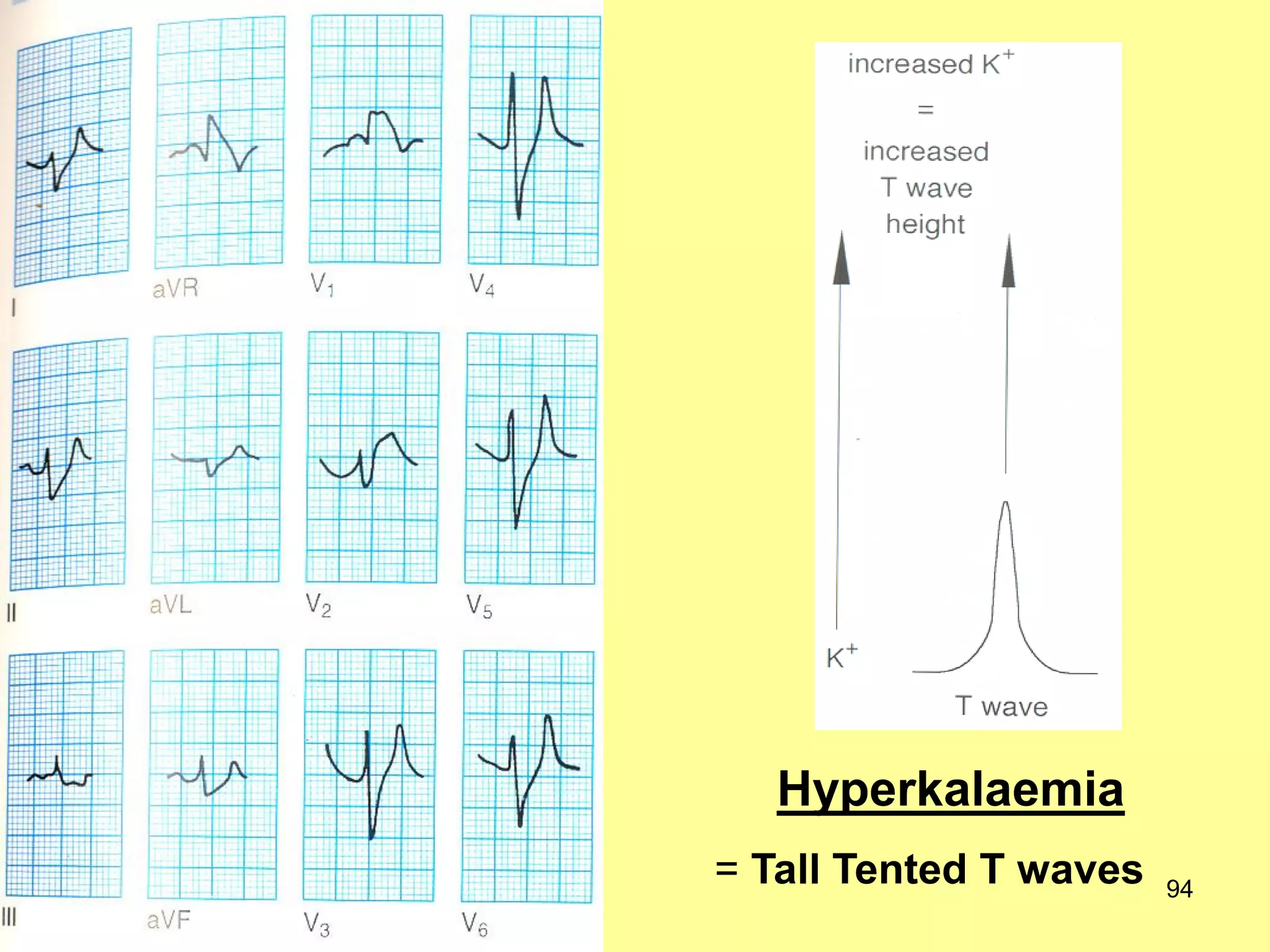 Hyperkalaemia
= Tall Tented T waves

94

 