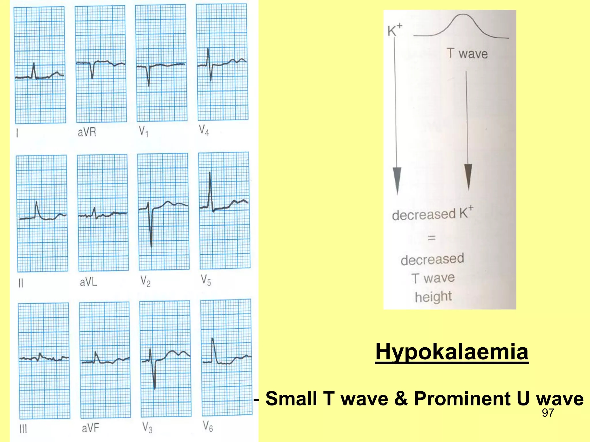 Hypokalaemia
- Small T wave & Prominent U wave
97

 