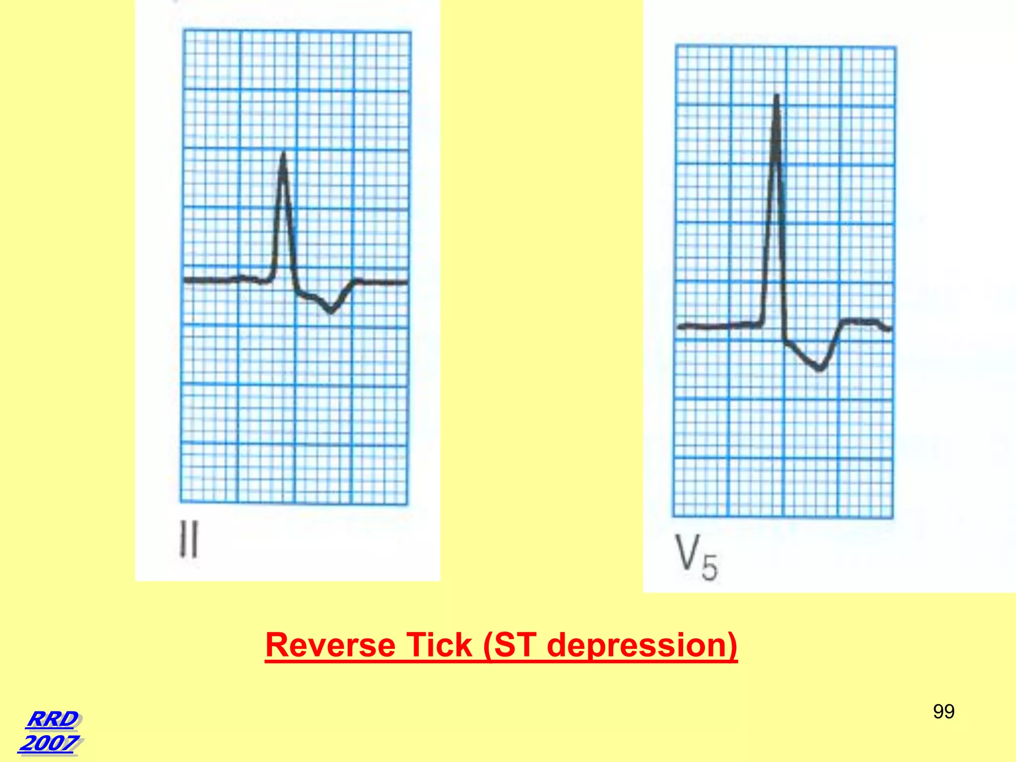 Reverse Tick (ST depression)
99

 