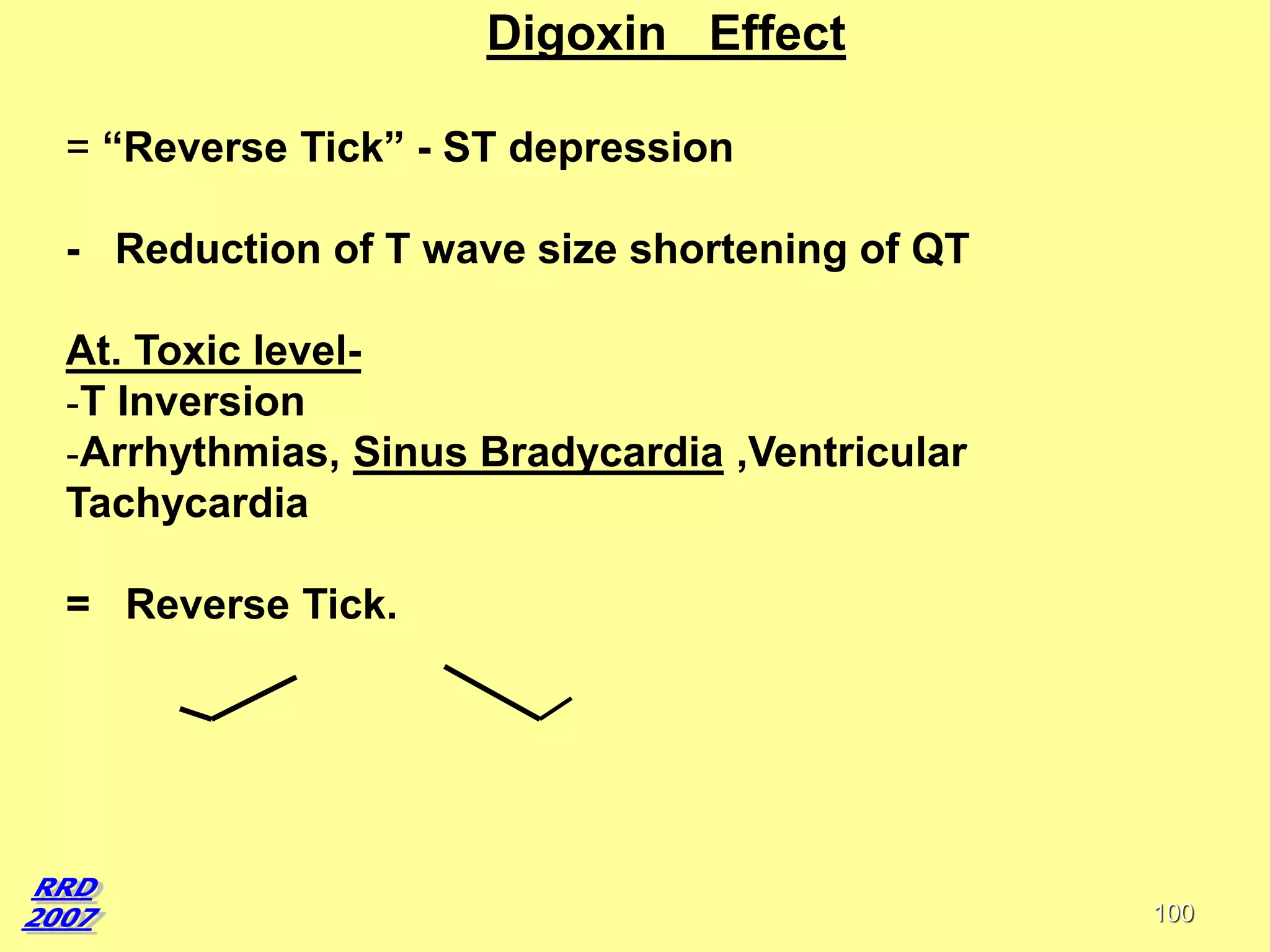 Digoxin Effect
= “Reverse Tick” - ST depression
- Reduction of T wave size shortening of QT

At. Toxic level-T Inversion
-Arrhythmias, Sinus Bradycardia ,Ventricular
Tachycardia
= Reverse Tick.

100

 