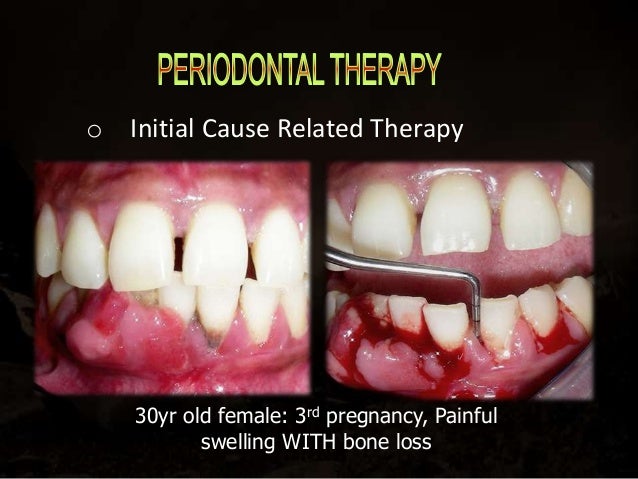 Current Approach In Periodontal Care