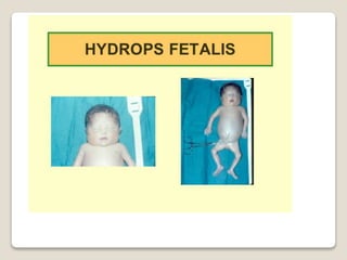 R.n.pretermino final