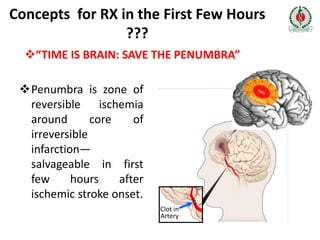 Recent Management of Acute ischaemic Stroke – An Update | PPTX