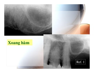 5   %$



         Ref. 1
 