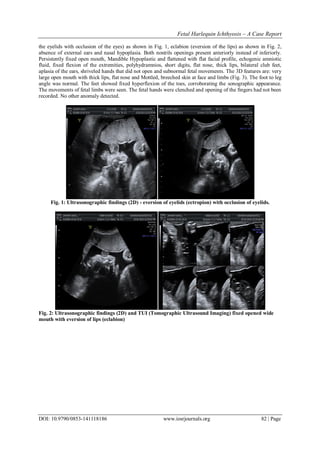 Fetal Harlequin Ichthyosis – A Case Report | PDF