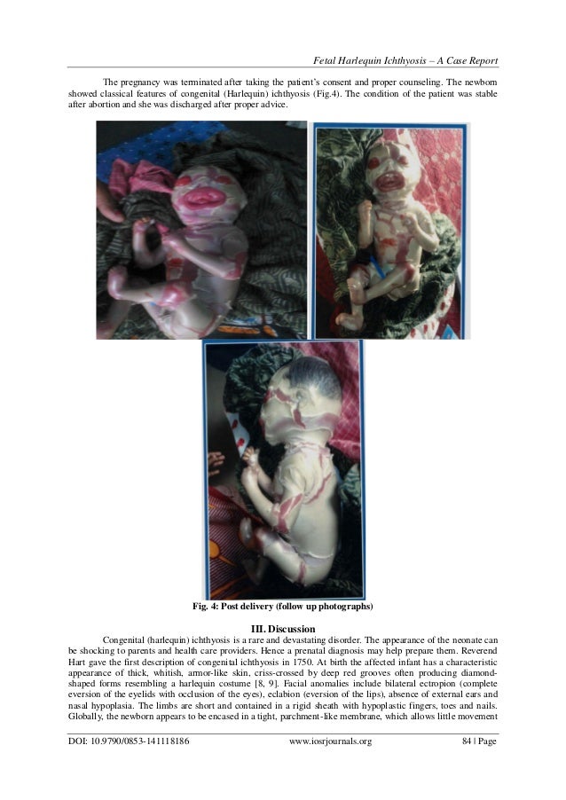 Fetal Harlequin Ichthyosis A Case Report Fetal Harlequin Ichthyosis A Case Report