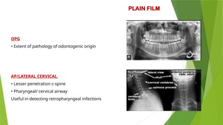 Opg Infection 1. Fascial Space Infection of Maxillofacial Region.pptx