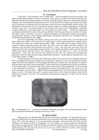 Open Apex with Mineral Trioxide Aggregate- Case Report | PDF
